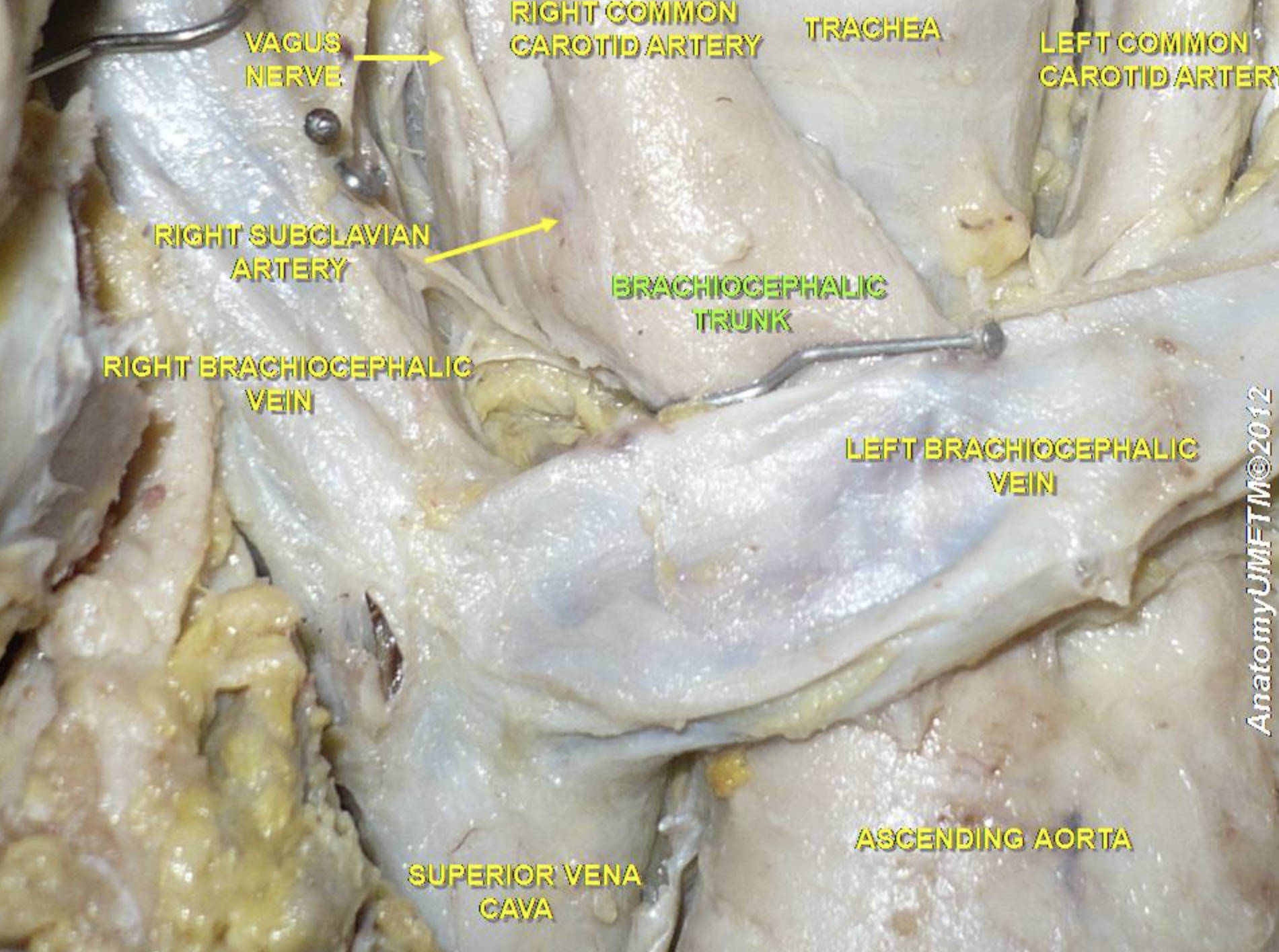 Anatomical Guide to the Brachiocephalic Trunk and Great Vessels of the Mediastinum