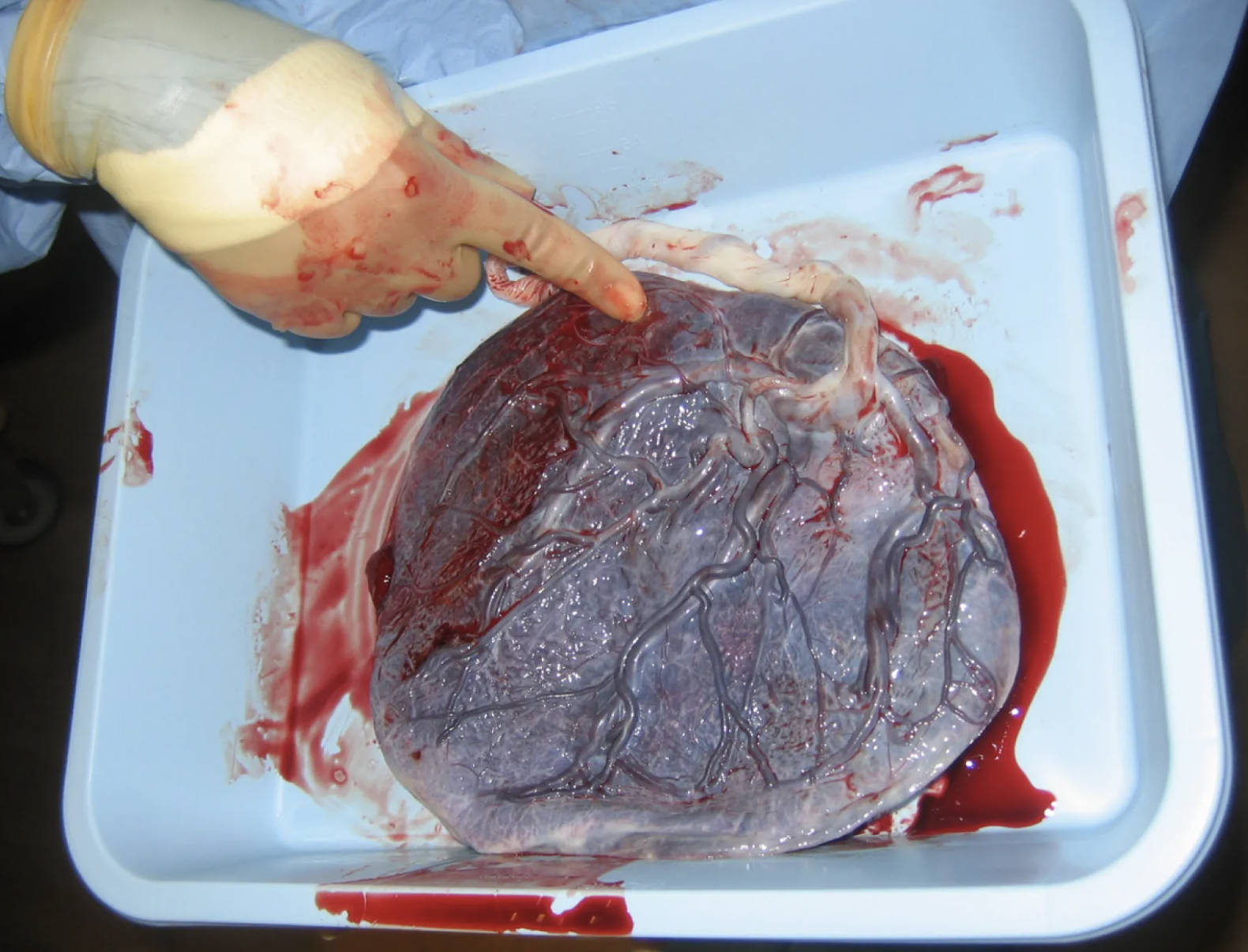 Post-Expulsion Placenta: A Detailed Examination of the Fetal Side