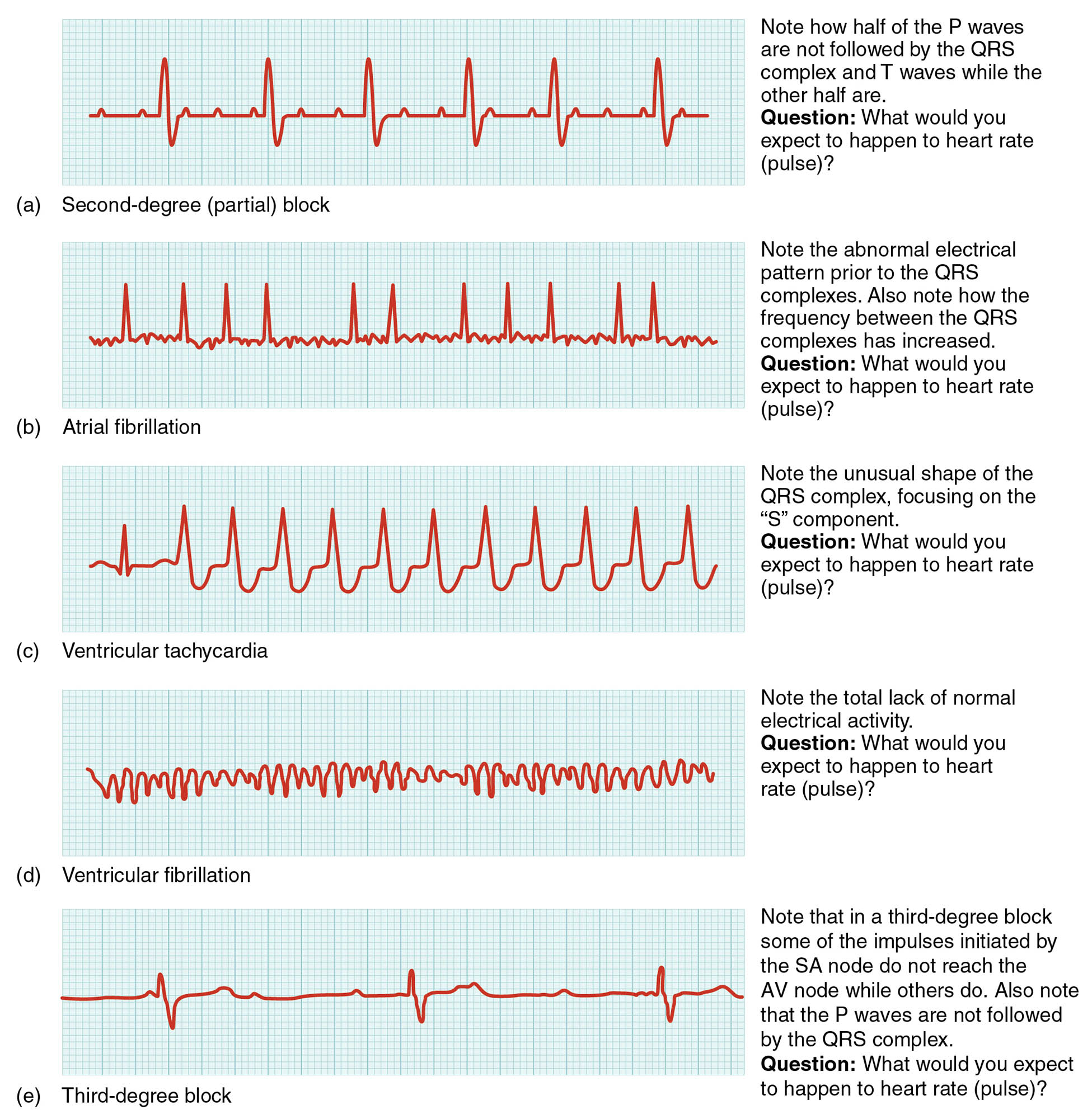 Common ECG Abnormalities Diagram: A Detailed Guide