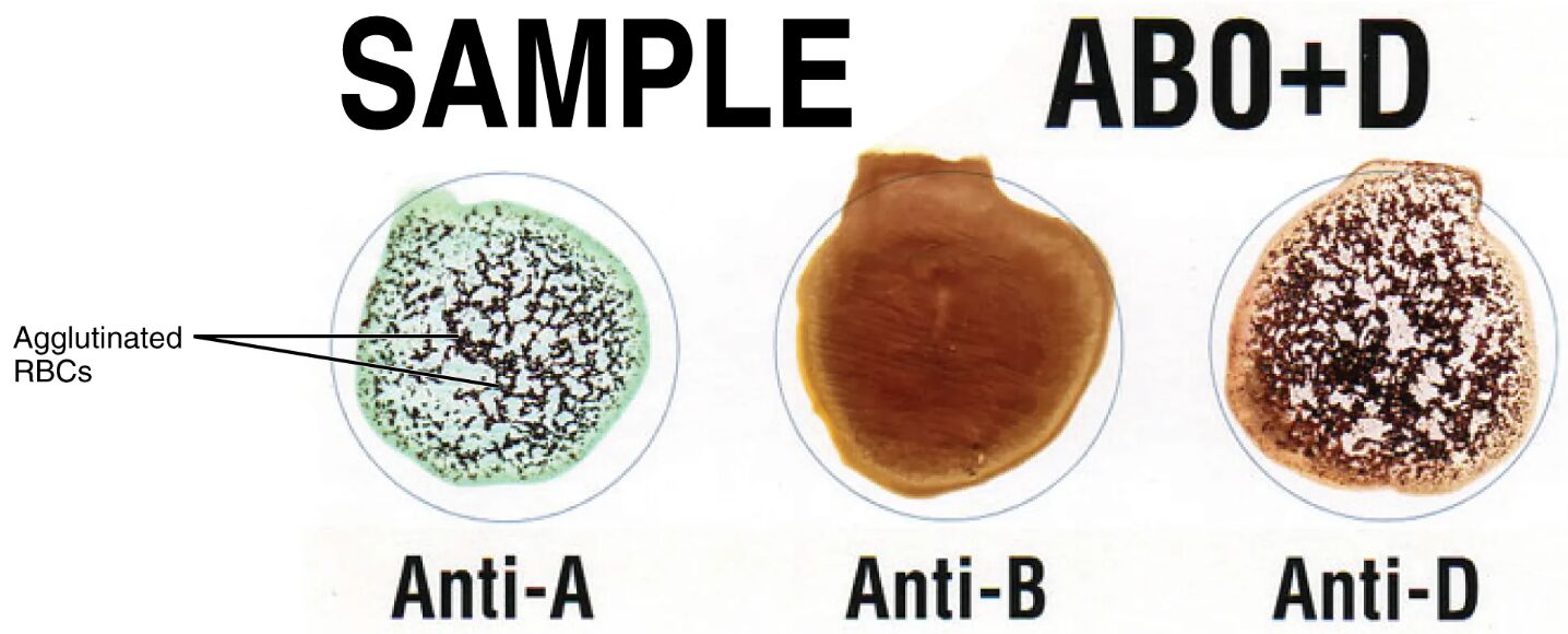 Mastering Blood Type Cross-Matching: ABO+D Testing Explained