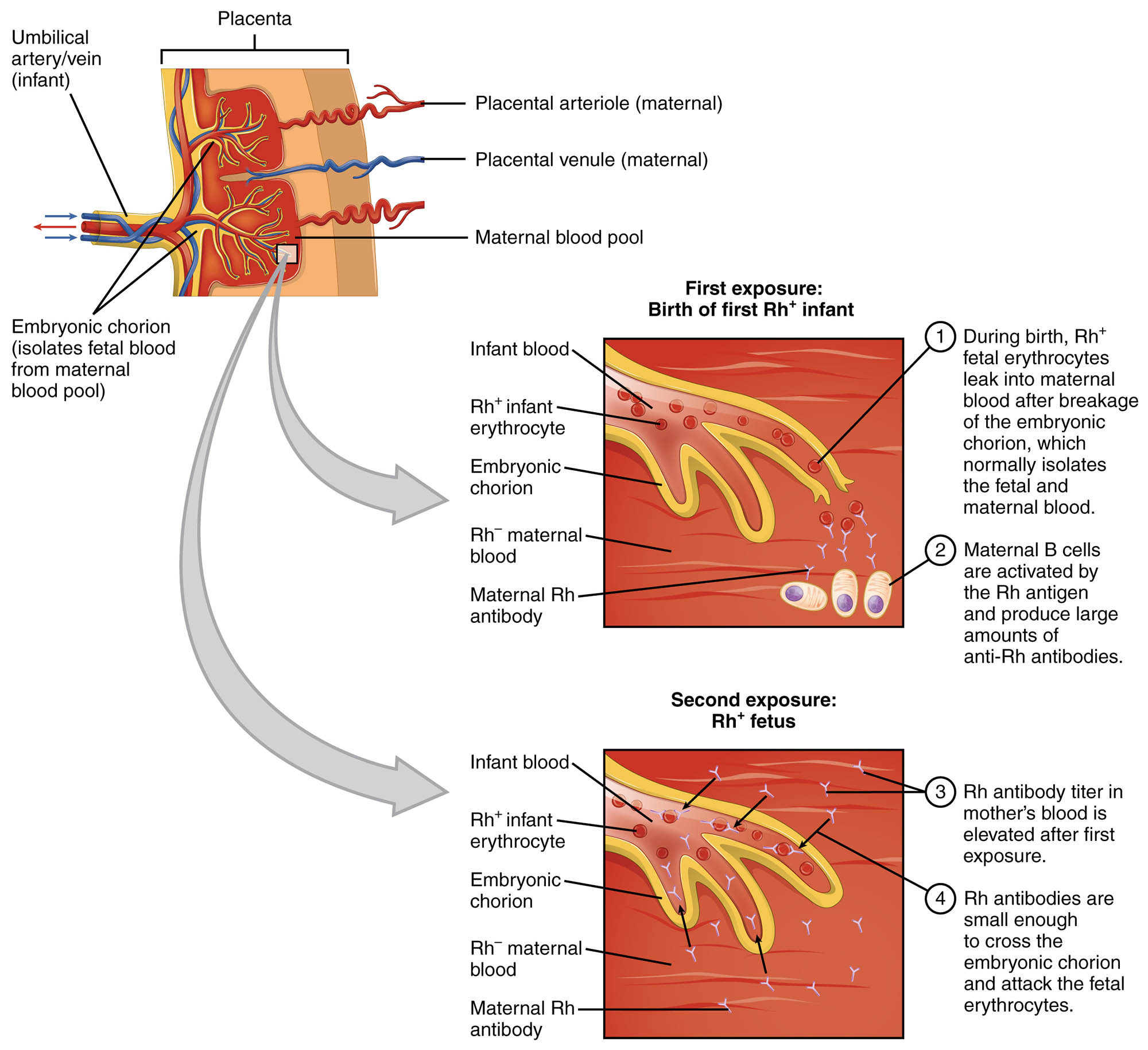 Understanding Erythroblastosis Fetalis: Causes and Mechanisms