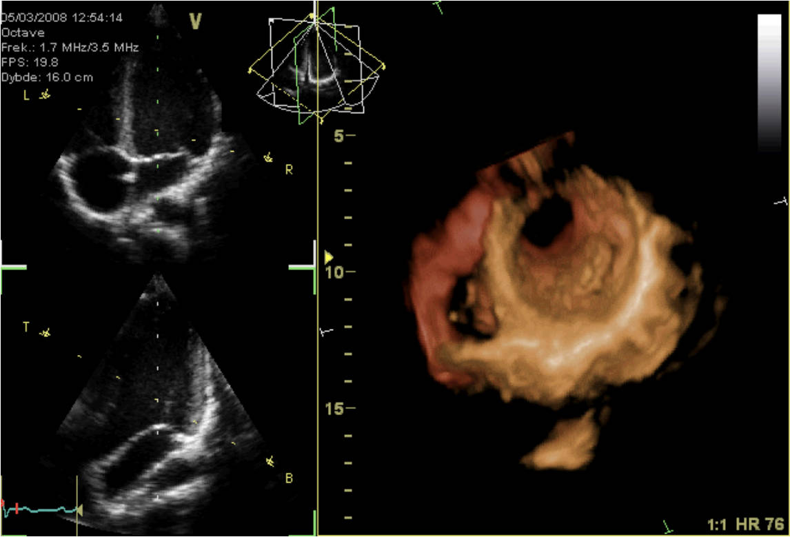 Decoding the Heart: An Echocardiogram’s Insights into Cardiac Health
