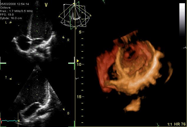 gif-animation-showing-a-moving-echocardiogram Decoding the Heart: An Echocardiogram's Insights into Cardiac Health