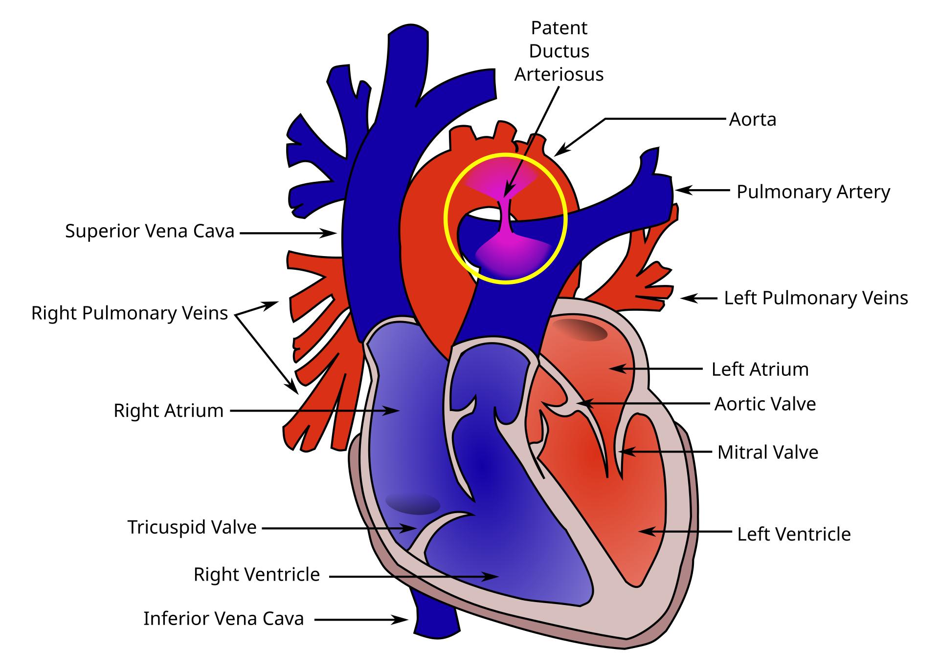 Understanding Patent Ductus Arteriosus (PDA): A Congenital Heart Condition