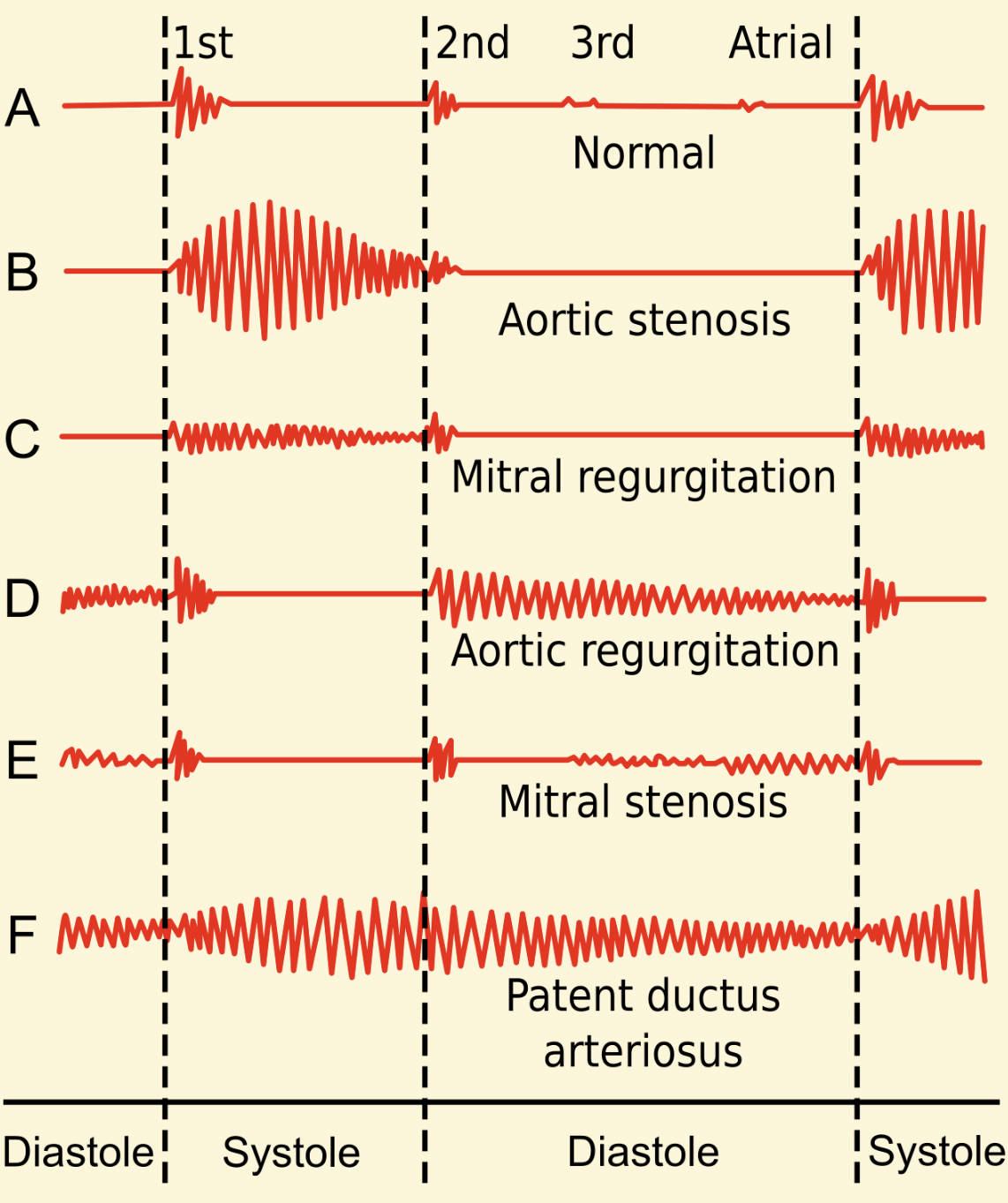 Understanding Heart Sounds: A Guide to Phonocardiograms