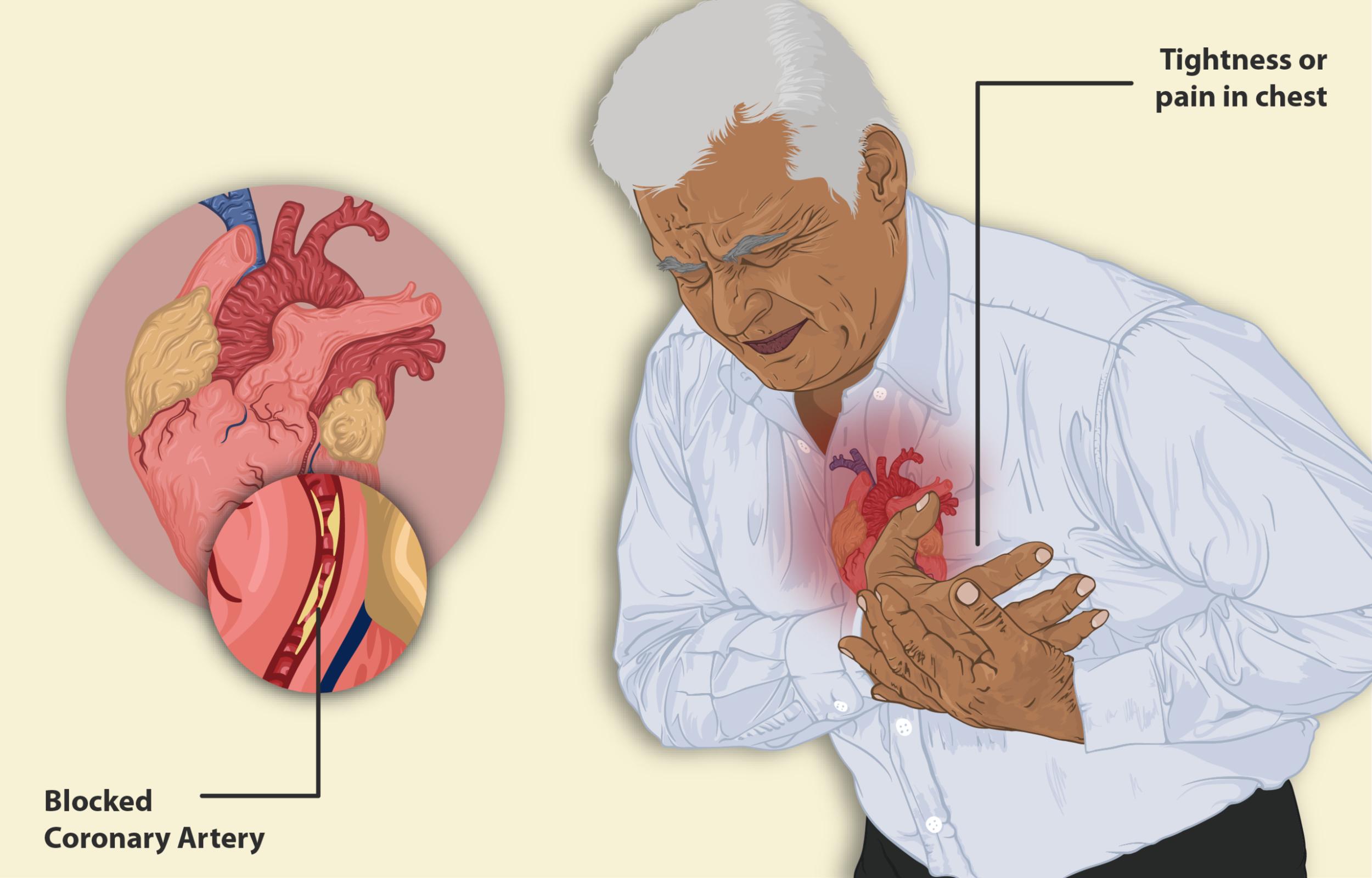 Recognizing a Heart Attack: Symptoms and Urgent Action