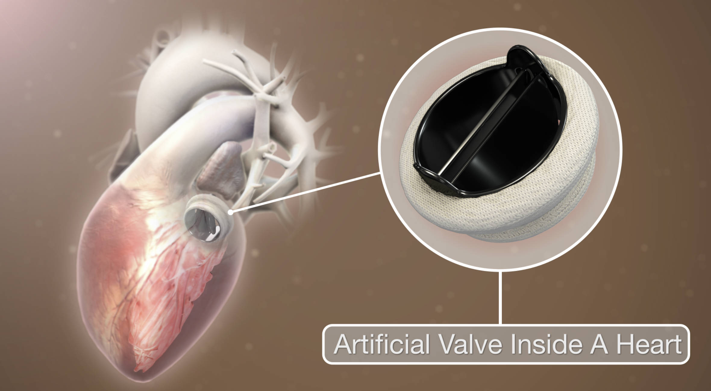 Artificial Heart Valve Replacement: Anatomy, Procedure, and Recovery