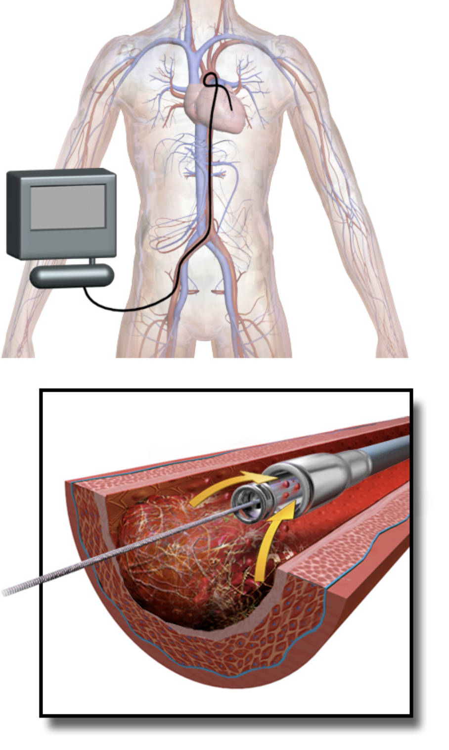AngioJet Thrombectomy: Rapid Clot Removal for Restored Blood Flow