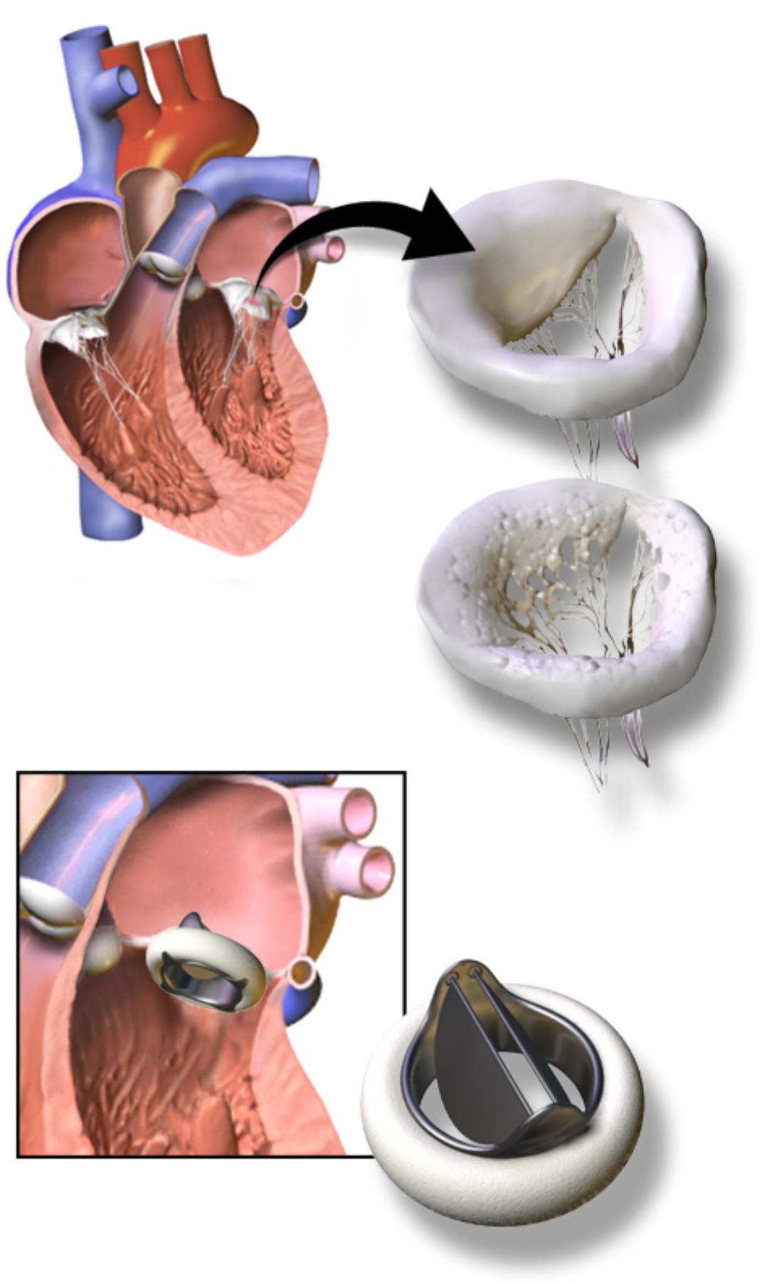 Artificial Heart Valves: Restoring Cardiac Function and Quality of Life