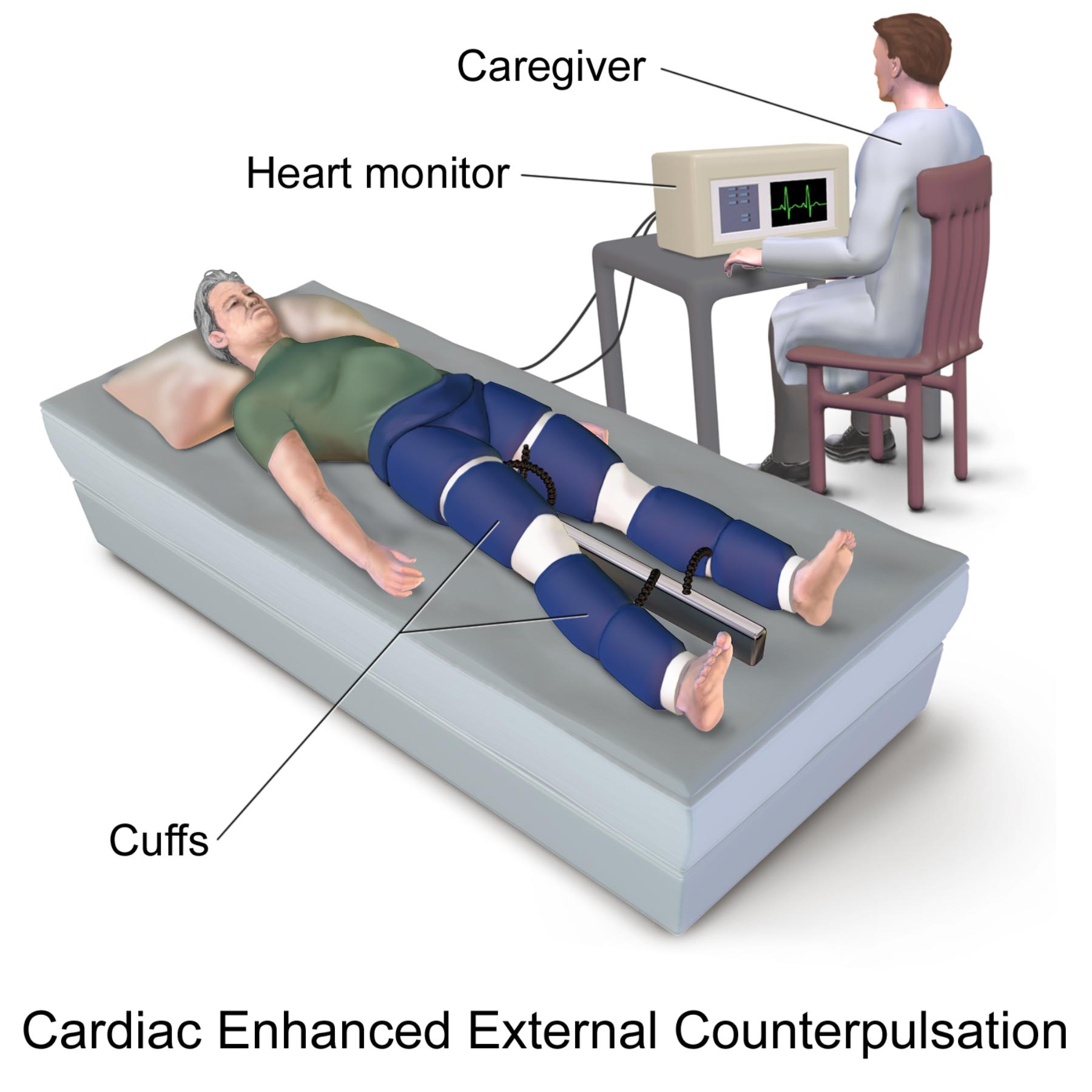 Enhanced External Counterpulsation (EECP): A Non-Invasive Cardiac Therapy