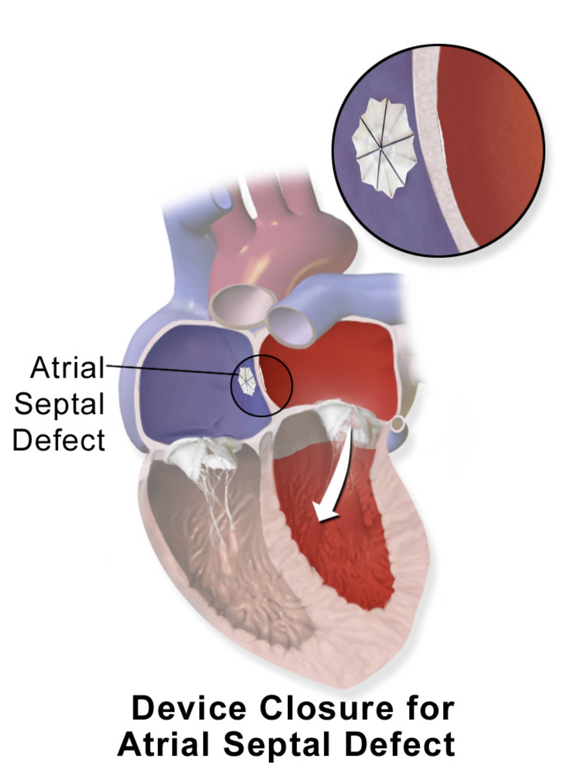 Atrial Septal Defect Closure: Minimally Invasive Solutions for Congenital Heart Disease