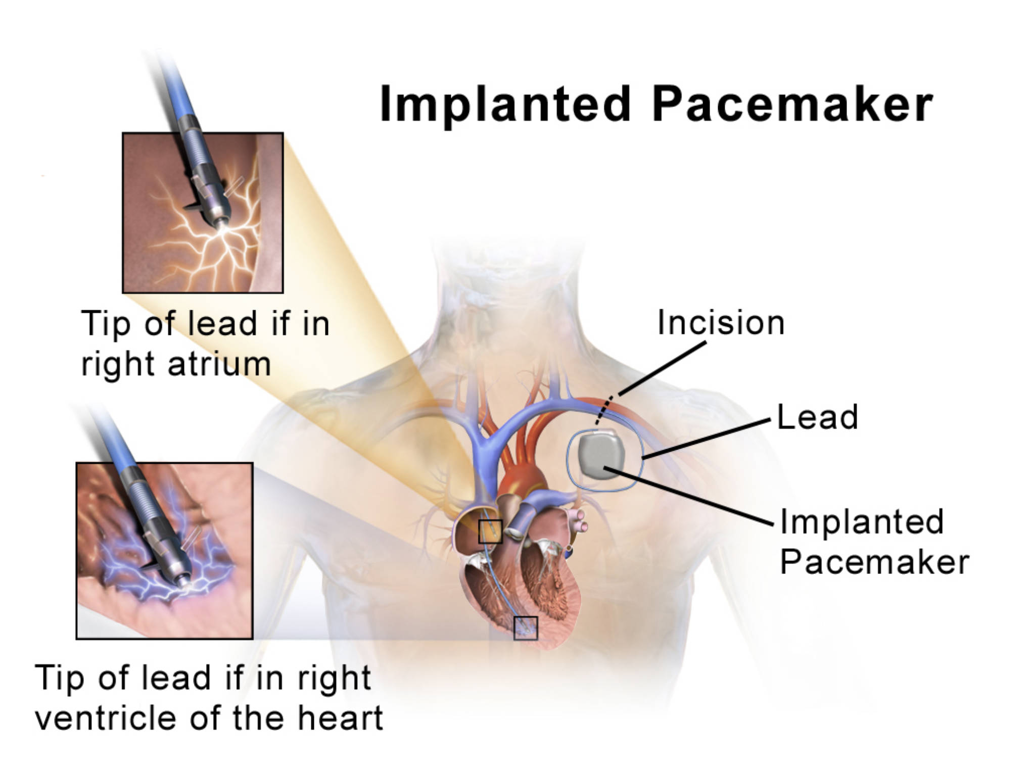 Implanted Pacemakers: Regulating Heart Rhythm for a Healthier Life