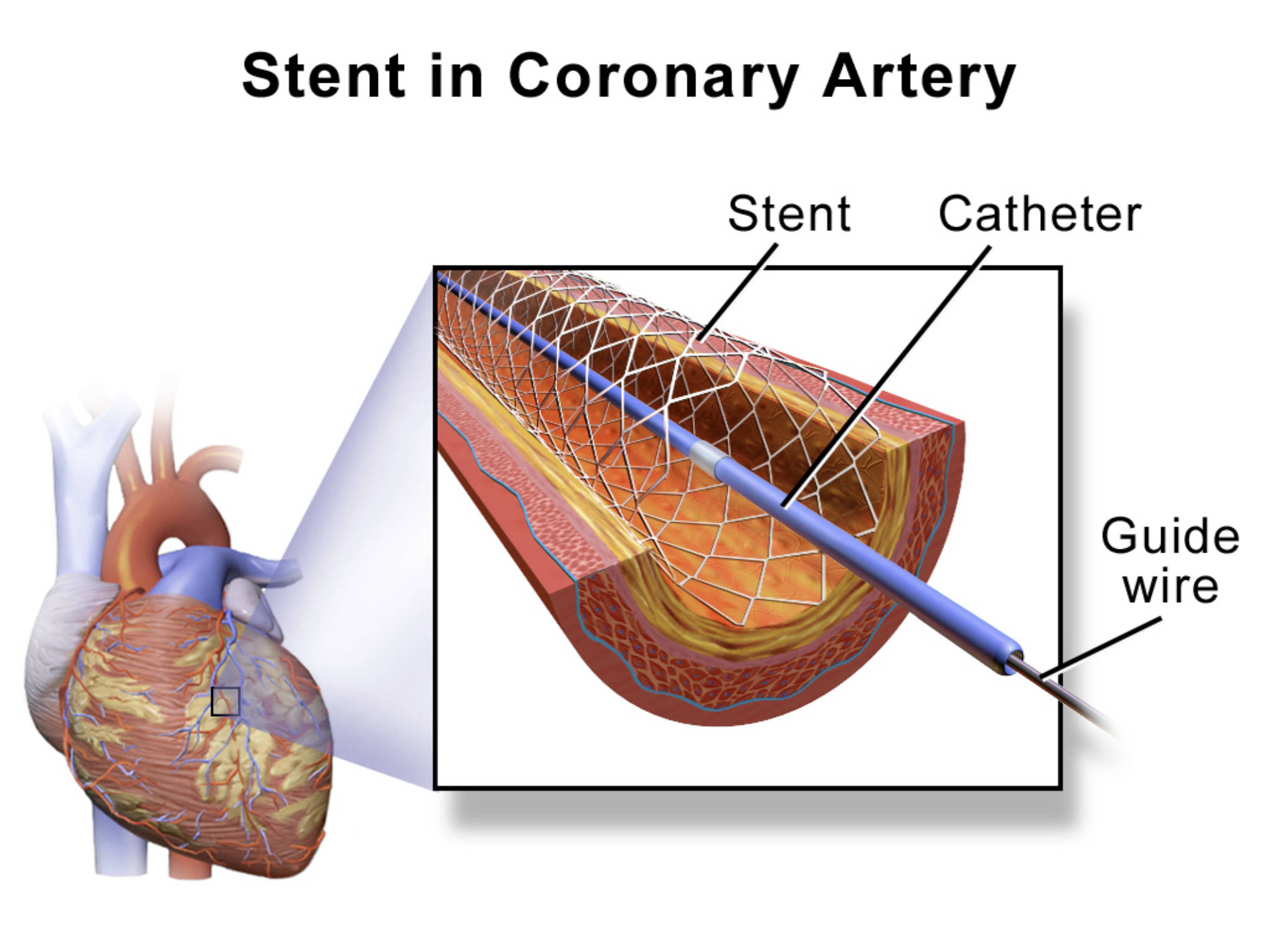 Coronary Stents: Restoring Blood Flow in Blocked Arteries