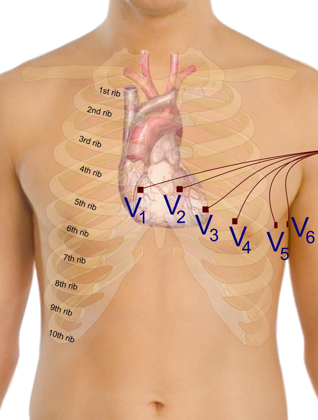 Correct Placement of Precordial Leads V1–V6: A Clinical Guide to ECG Anatomy