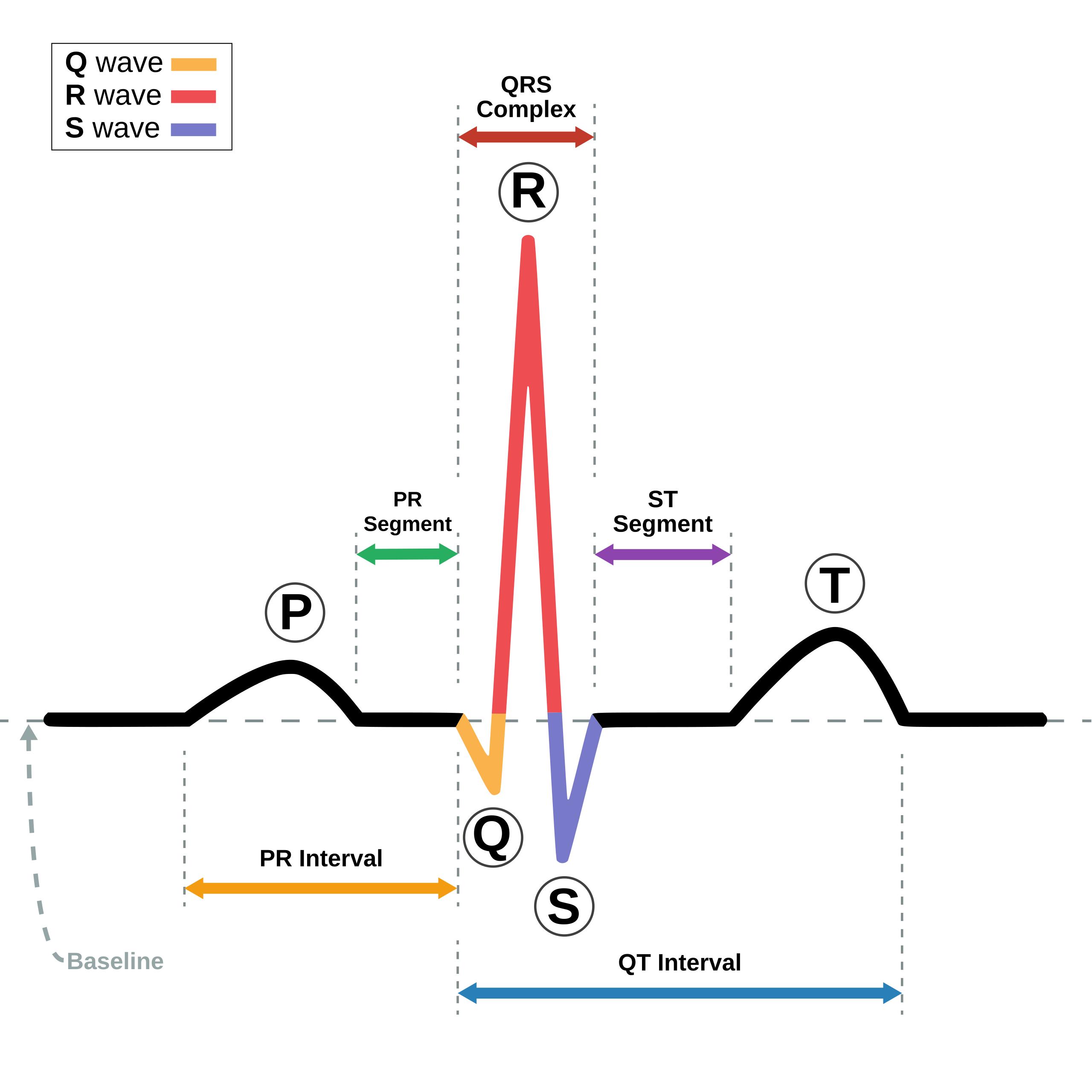 Understanding Normal Sinus Rhythm: A Guide to ECG Components and Physiology