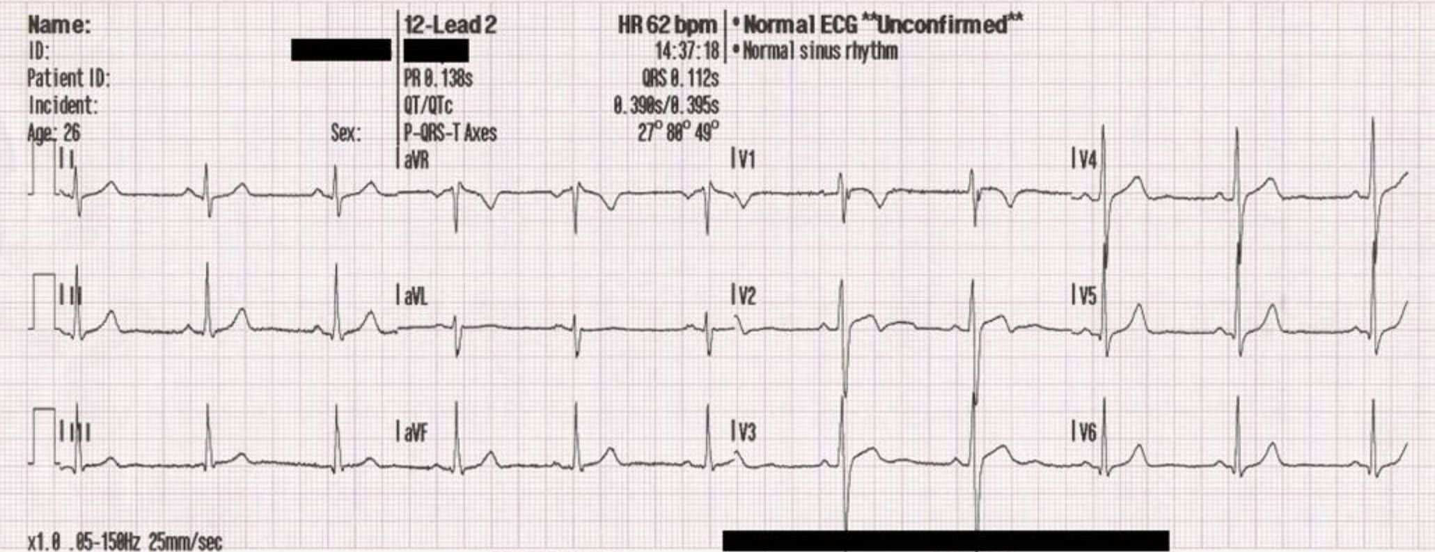 A Guide to Interpreting the 12-Lead ECG: Physiology and Analysis