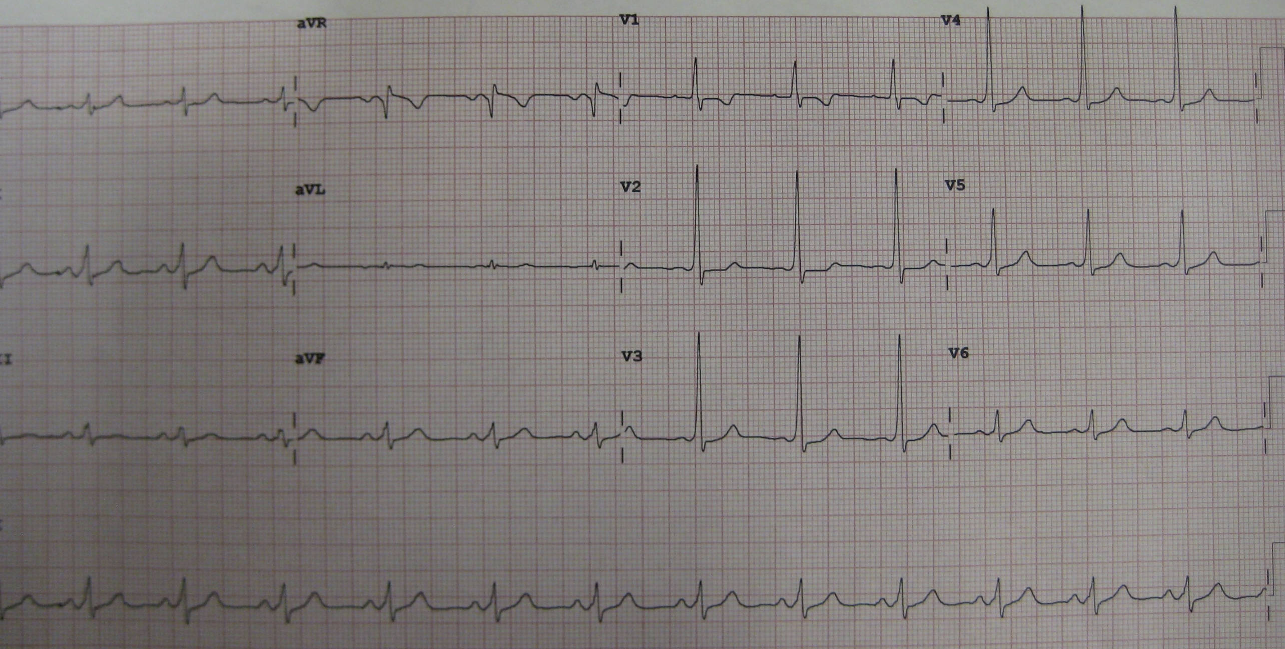 Diagnosing Wolff-Parkinson-White Syndrome on a 12-Lead ECG
