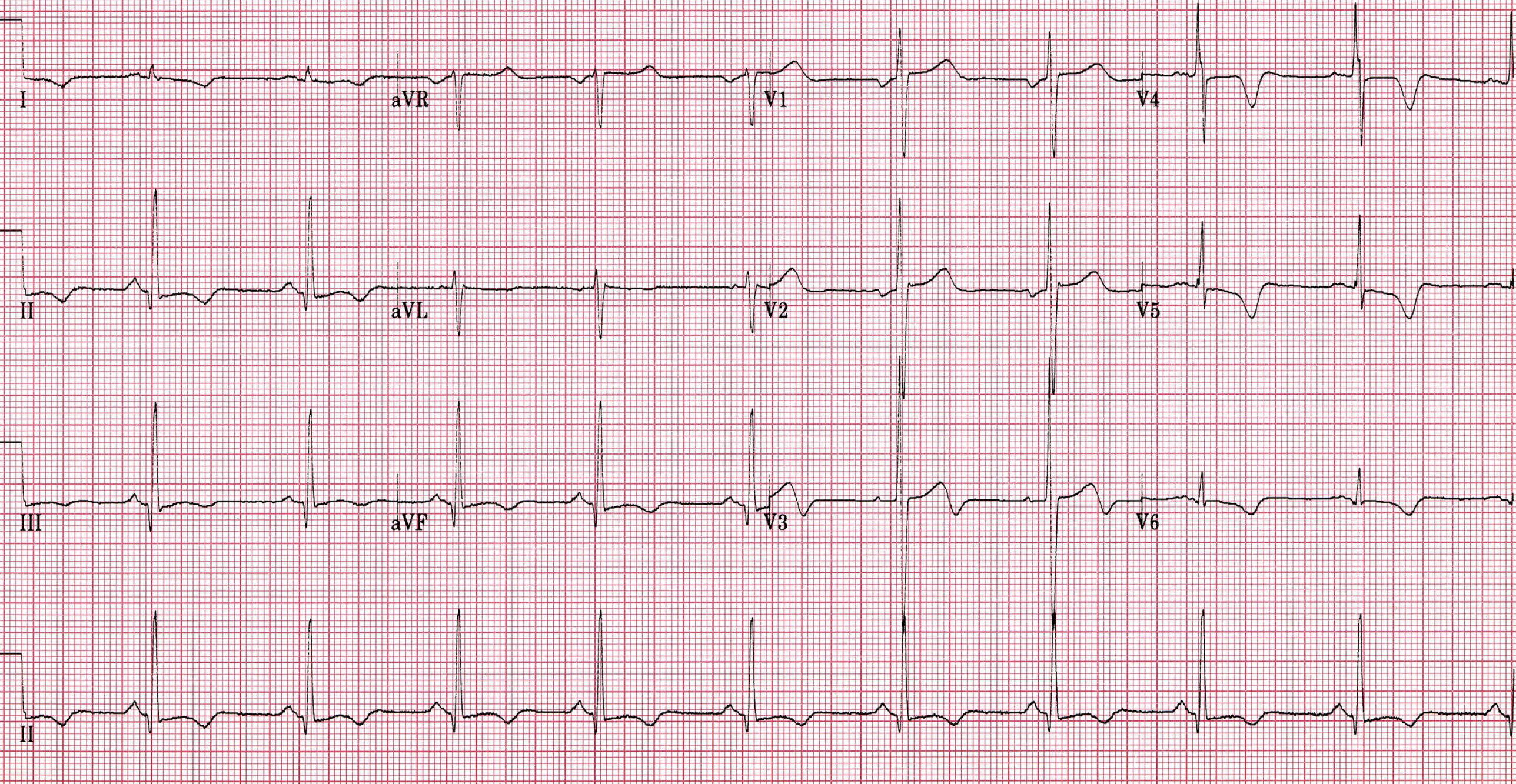 Decoding HOCM on ECG: A Guide to Hypertrophic Obstructive Cardiomyopathy