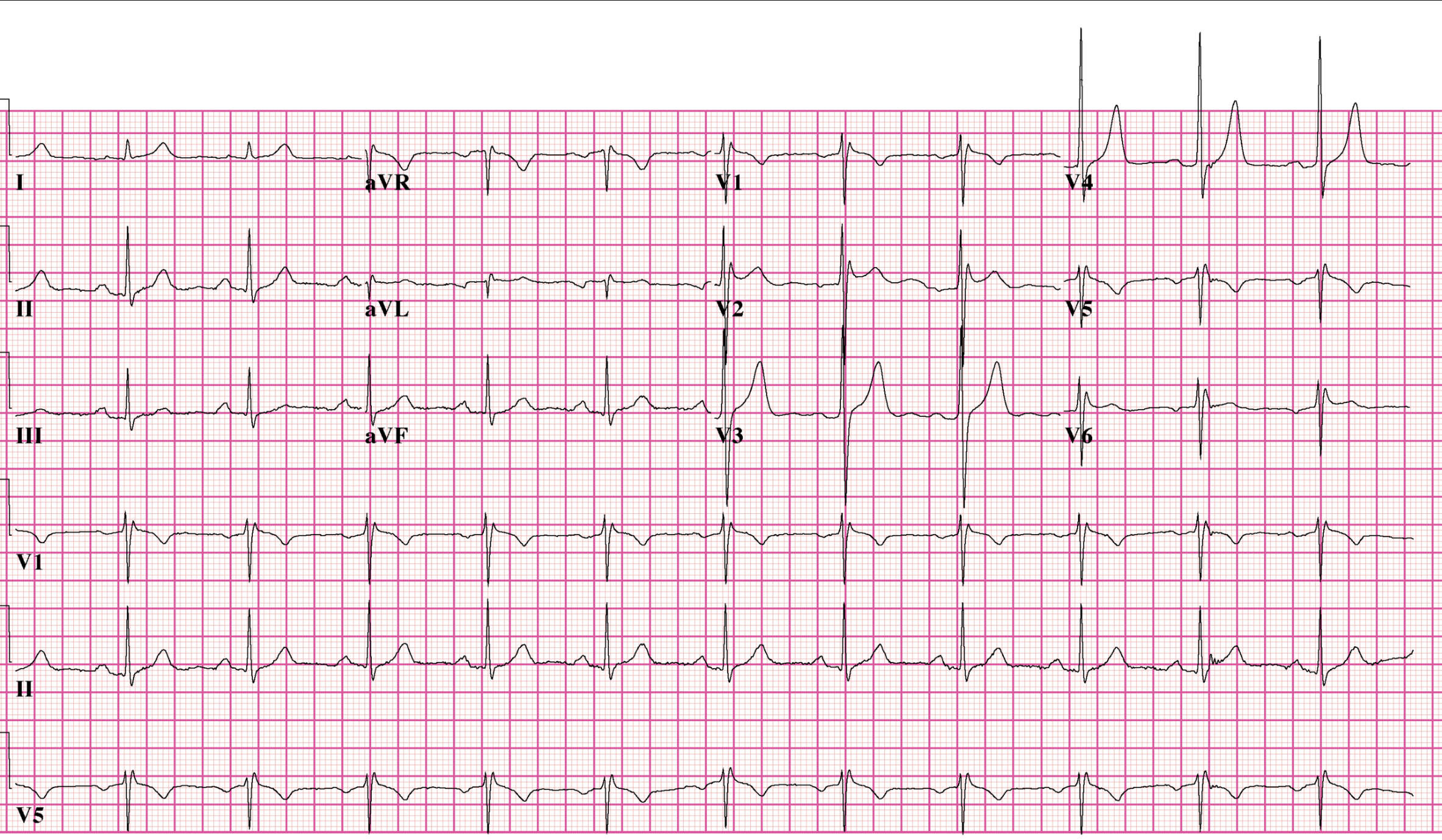 Recognizing Brugada Syndrome Type 2 on ECG: A Diagnostic Challenge