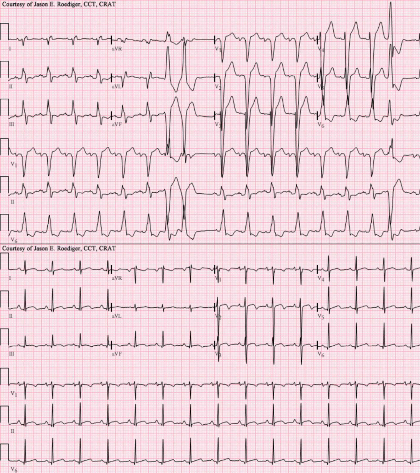 Understanding ECGs: Left Bundle Branch Block, Right Axis Deviation, and Post-Transplant Findings