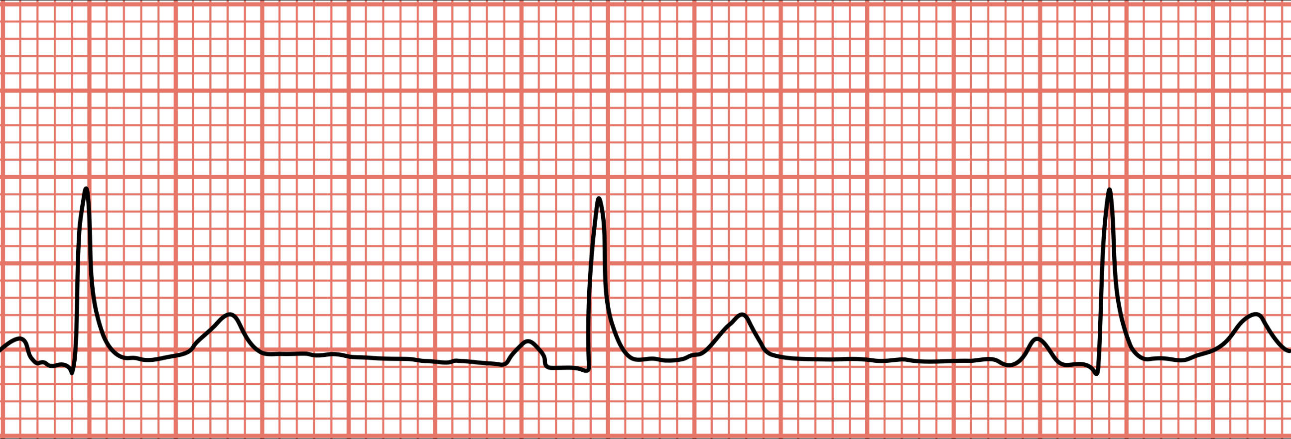 Understanding Sinus Bradycardia: An ECG Interpretation Guide