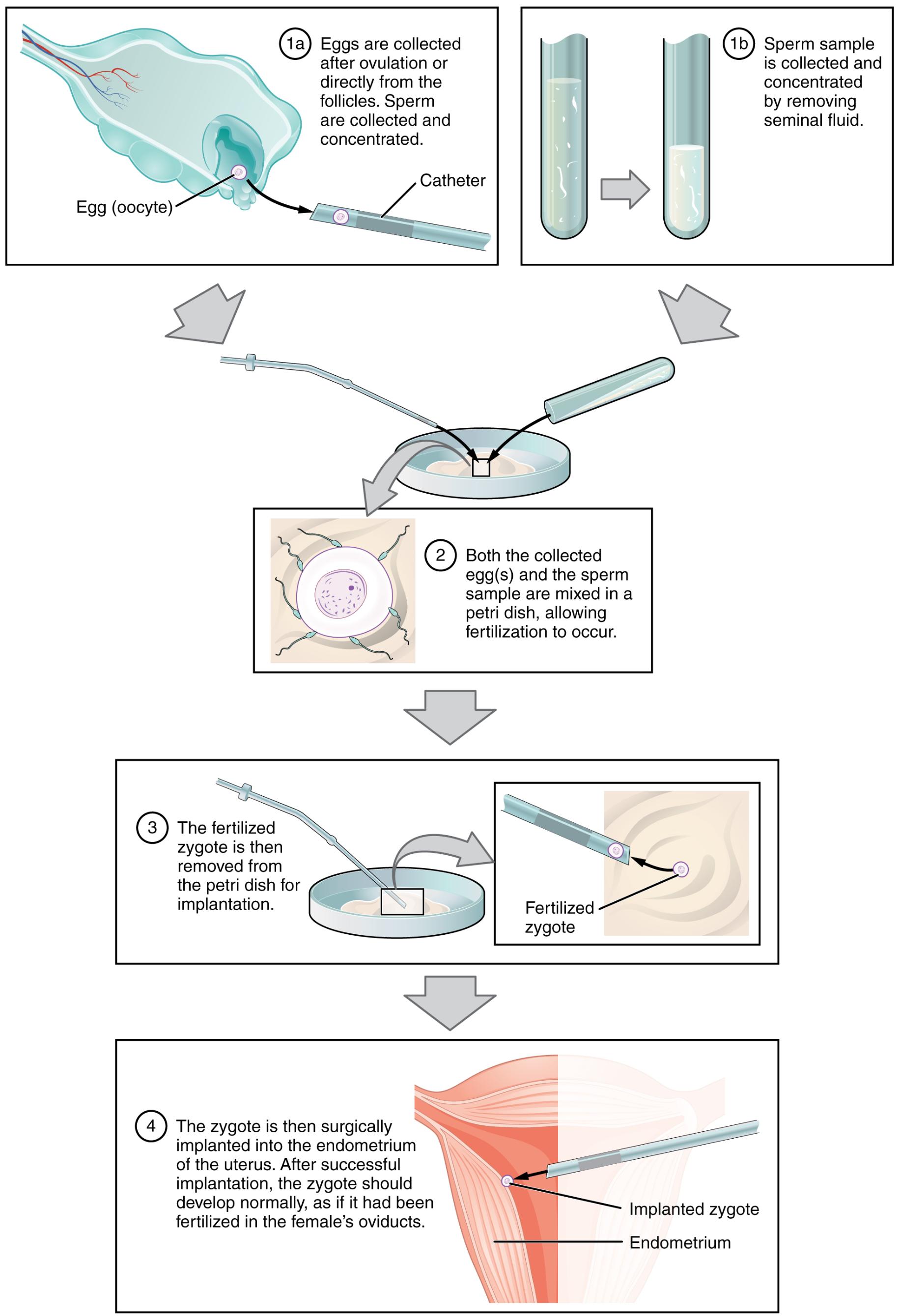 IVF: A Step-by-Step Guide to In Vitro Fertilization