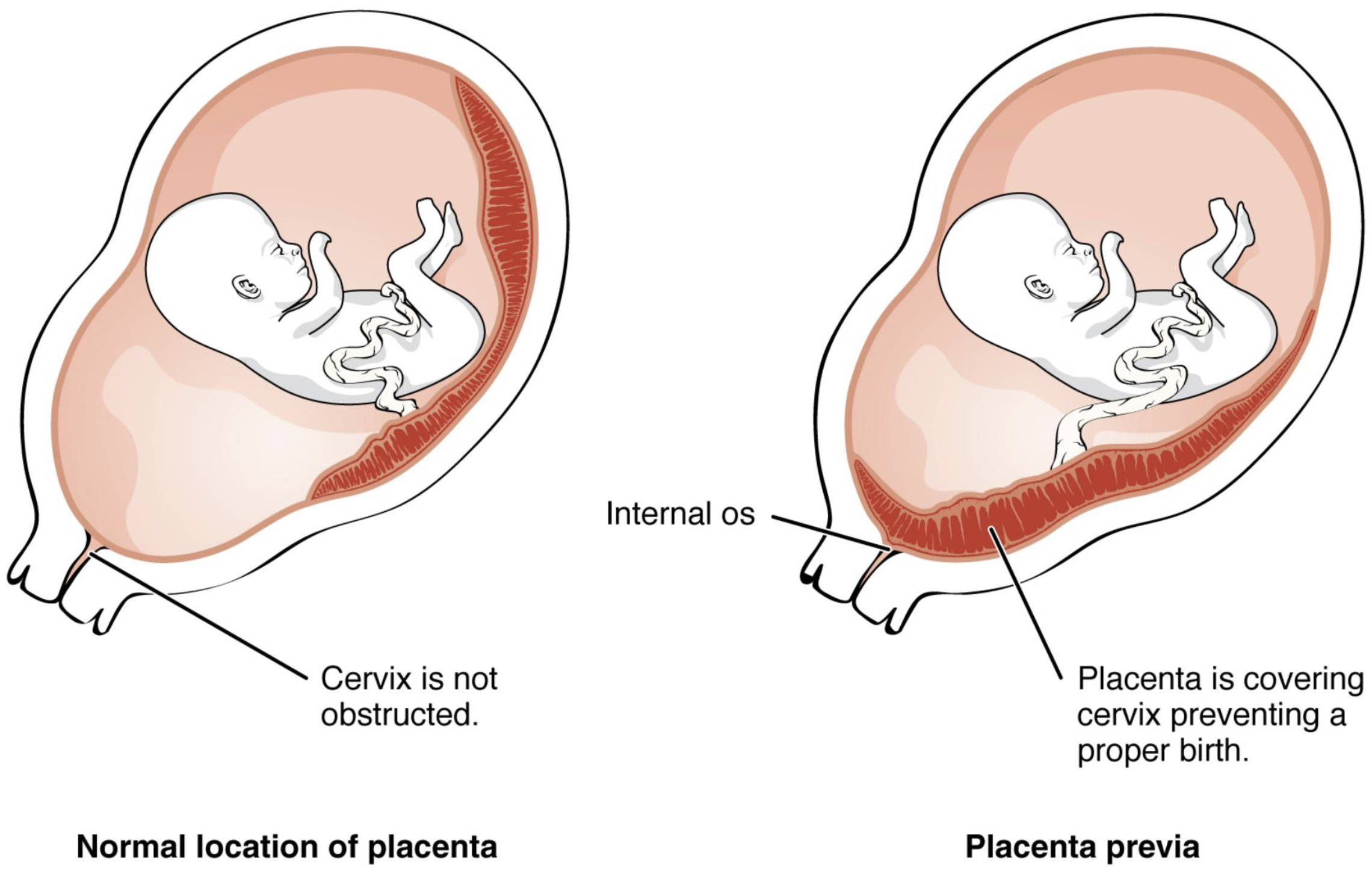 Placenta Previa: Understanding Normal vs. Abnormal Placental Implantation