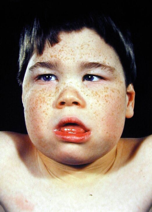 ARTX Syndrome: Understanding a Rare X-Linked Intellectual Disability