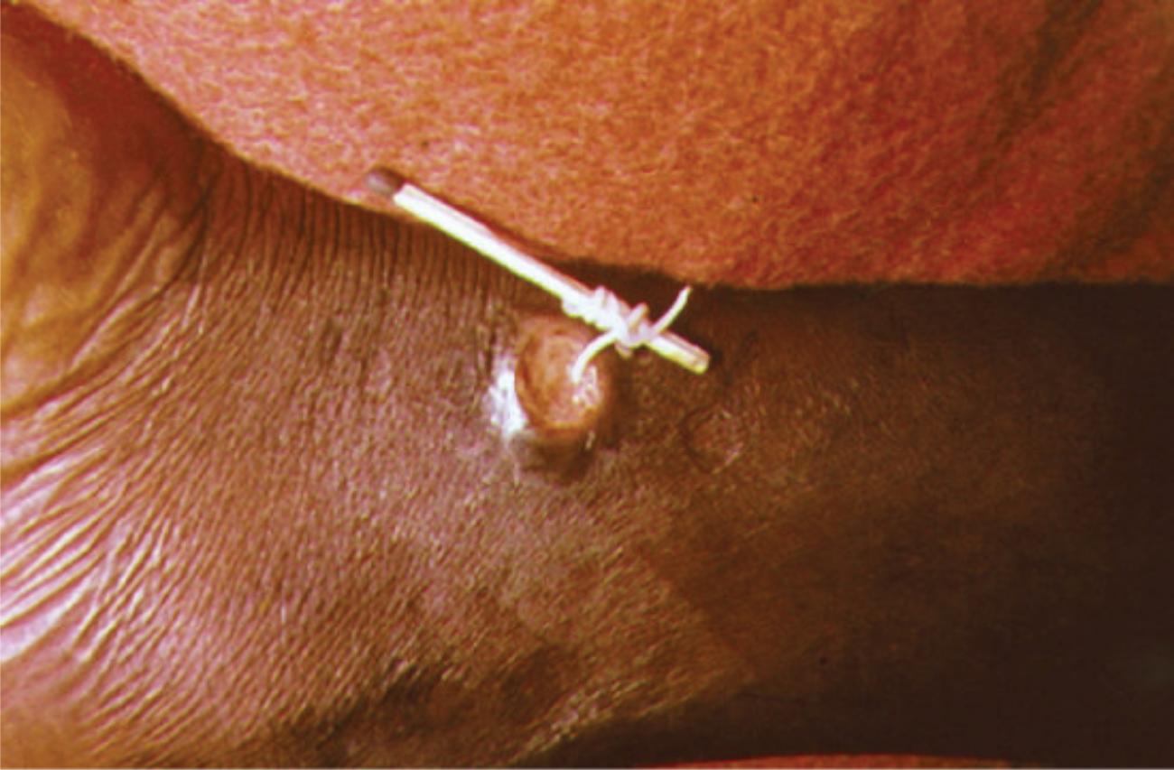 Dracunculiasis (Guinea Worm Disease): Clinical Overview and Extraction of Dracunculus Medinensis