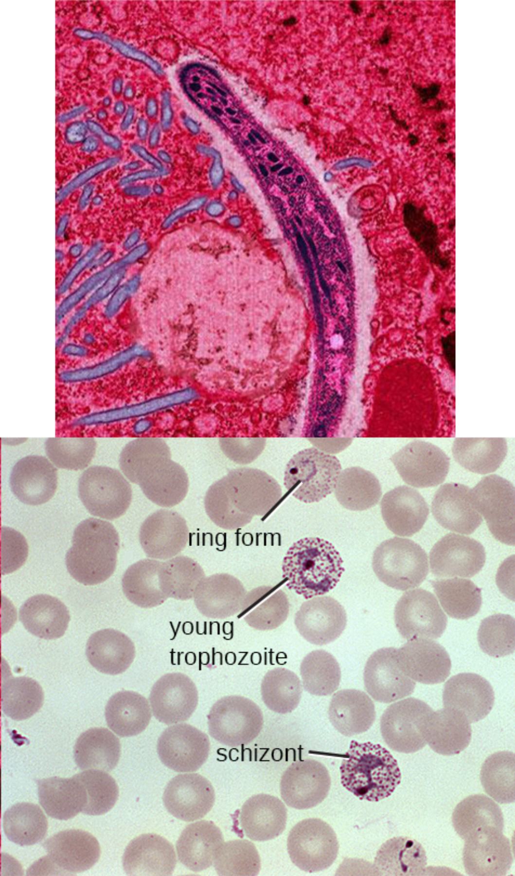 Malaria Blood Smear: Sporozoite, Trophozoites, and Schizont Stages