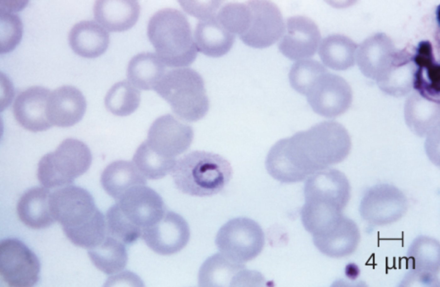 Diagnostic Identification of Ring-Shaped Plasmodium ovale in Malaria Blood Smears