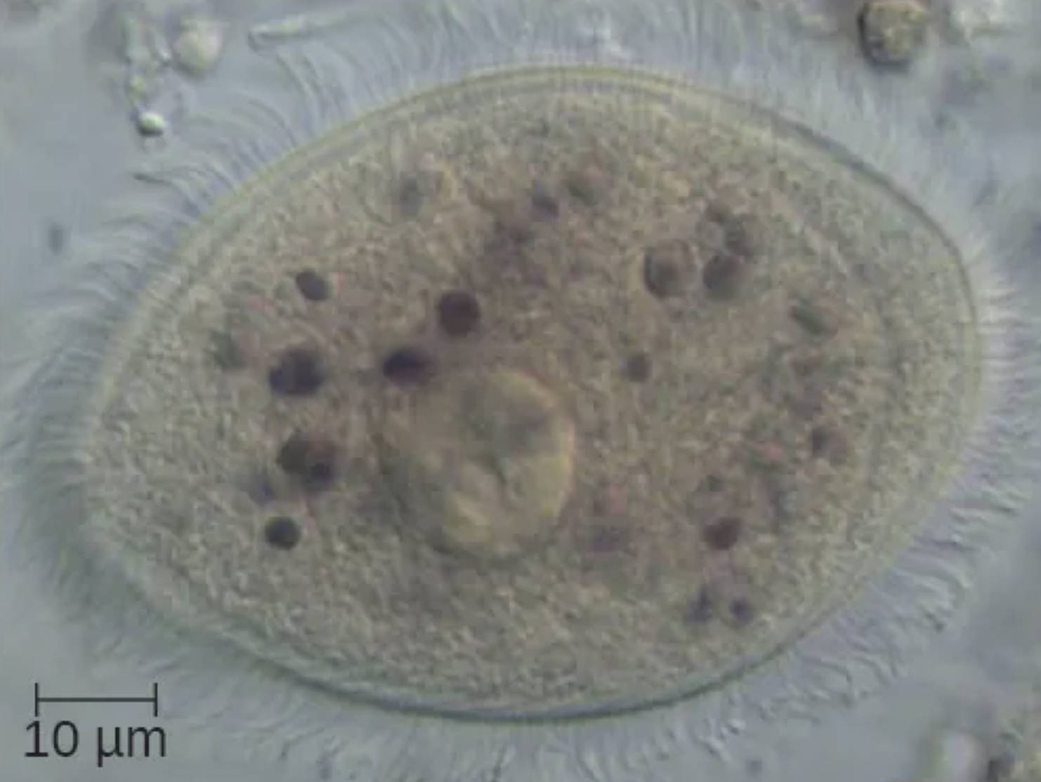 Balantidium coli Specimen: Ciliate Parasite and Human Balantidiasis