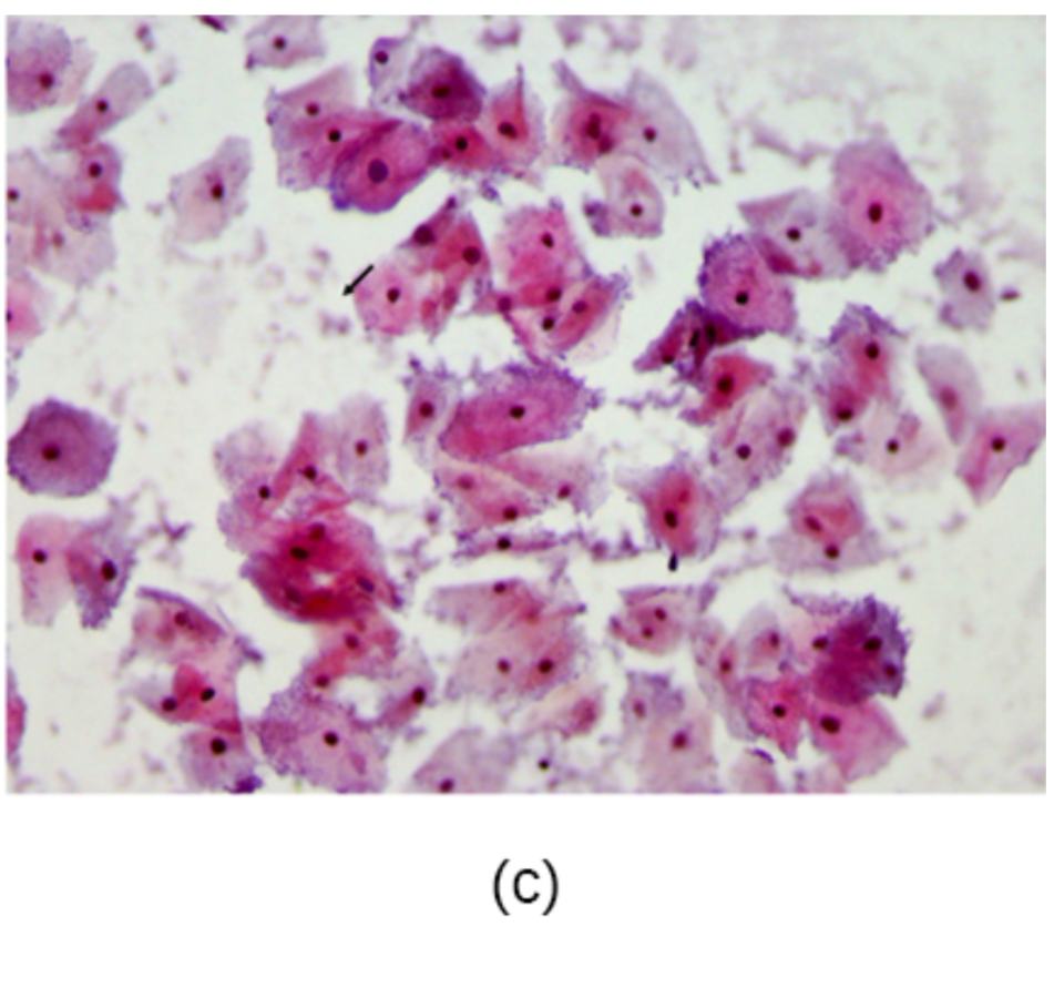 Gardnerella vaginalis and Bacterial Vaginosis: Understanding Clue Cells in Clinical Diagnostics