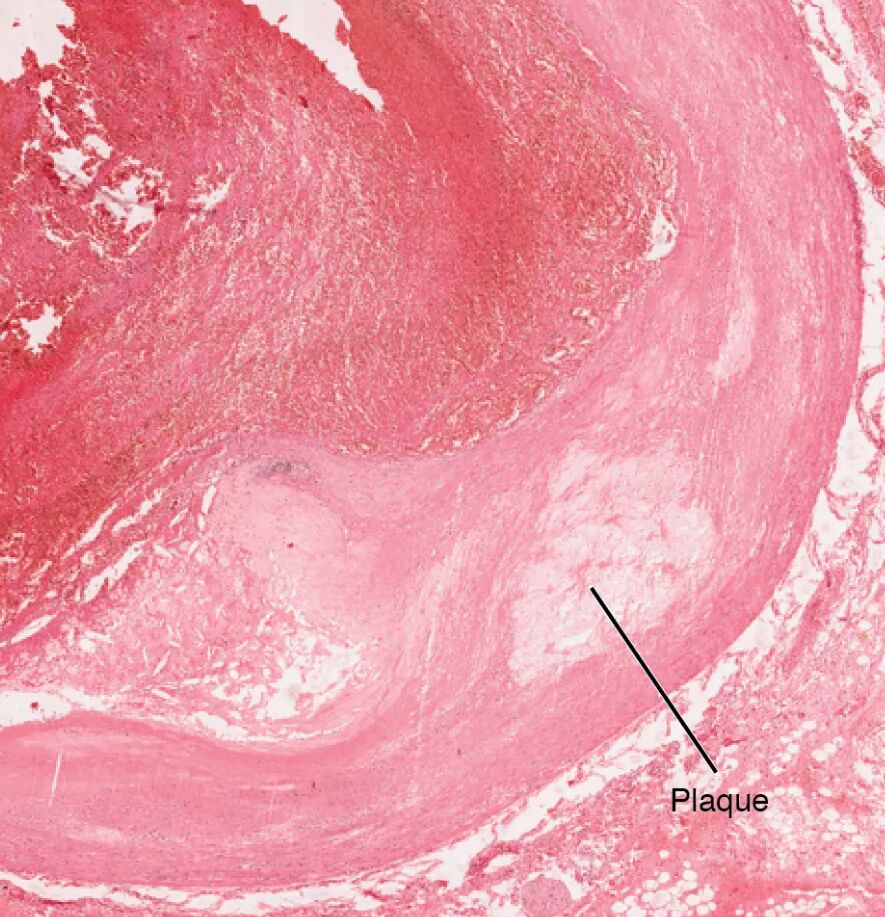 Atherosclerosis Microscopic View: Coronary Artery Insights