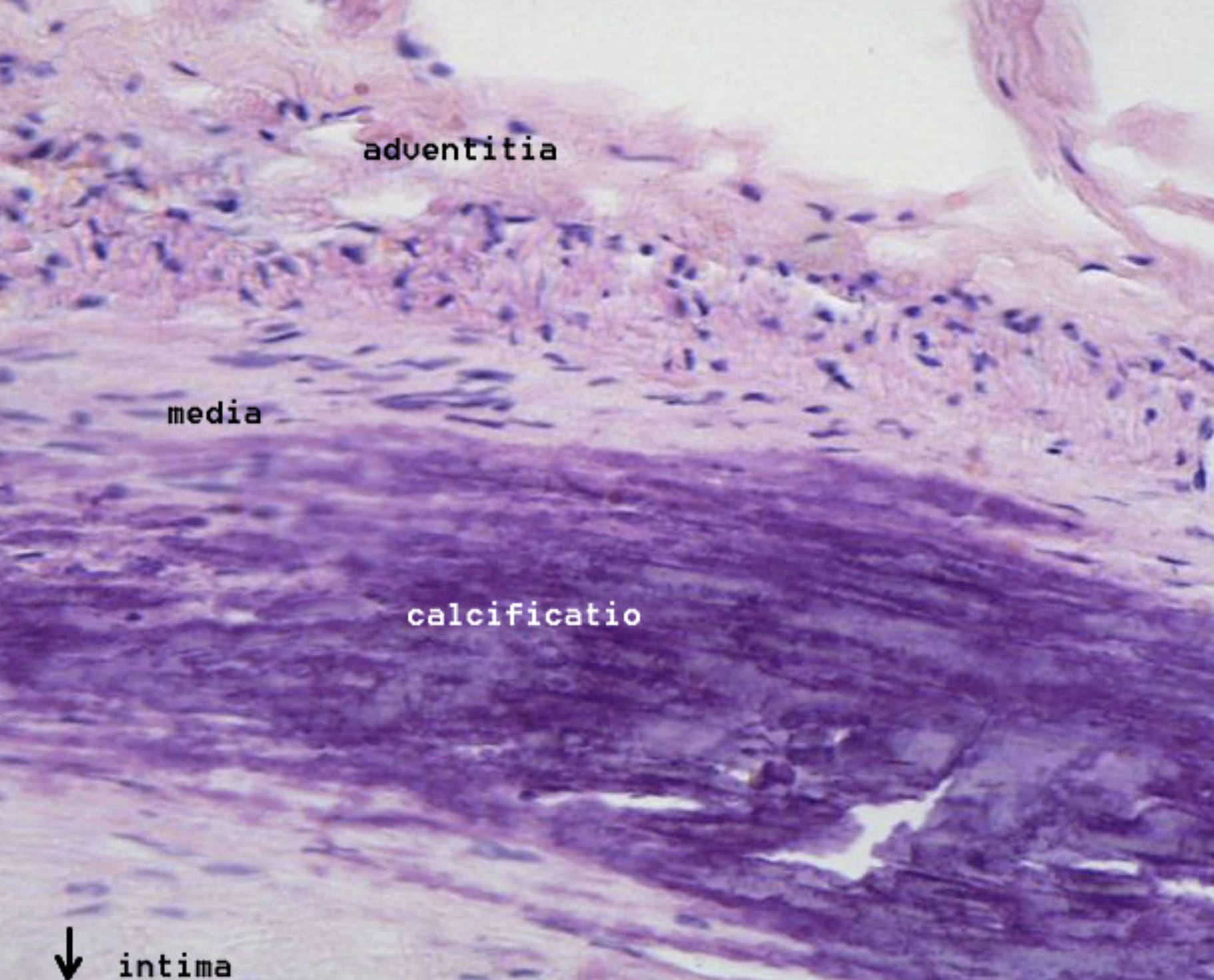 Calcific Atherosclerosis: A Microscopic Perspective on Arterial Hardening