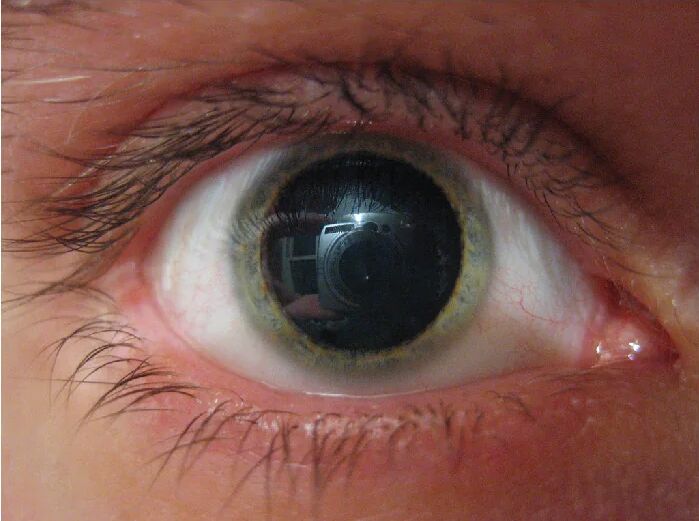 Understanding Mydriasis: Exploring Pupil Dilation in the Eye