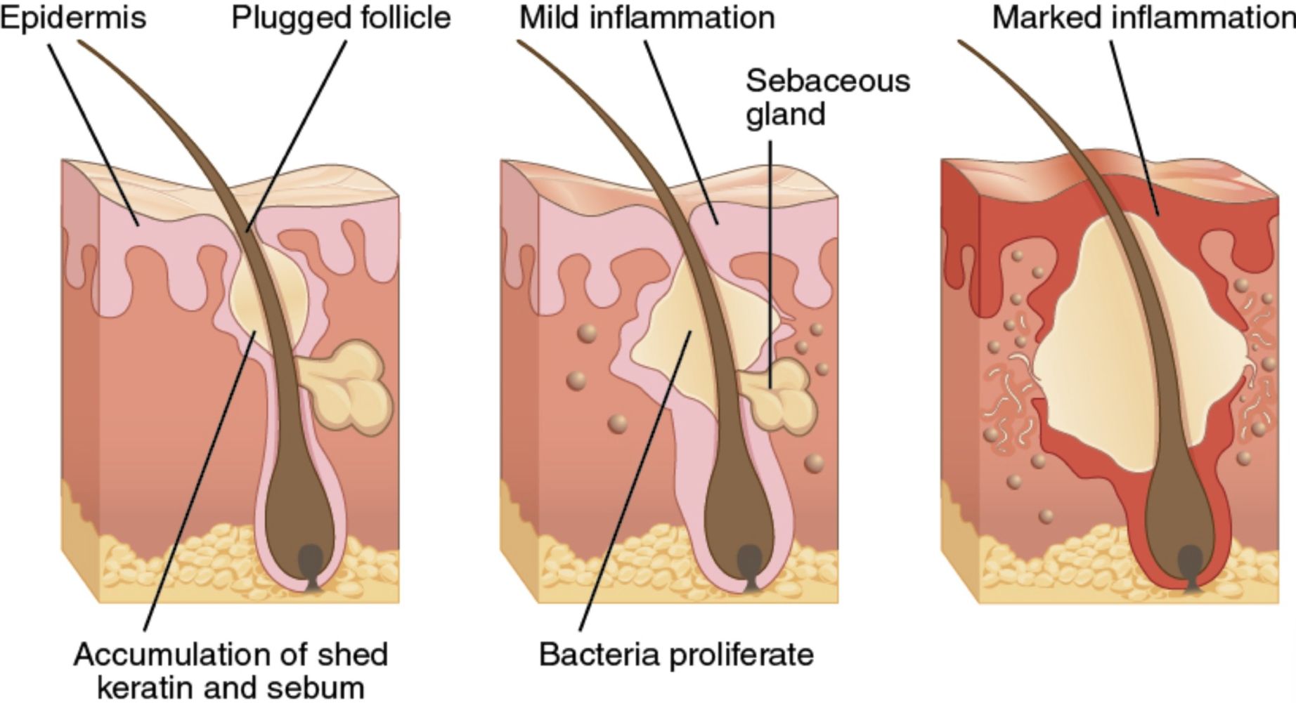 Acne Anatomy: Understanding the Development, Causes, and Treatment of Skin Inflammation