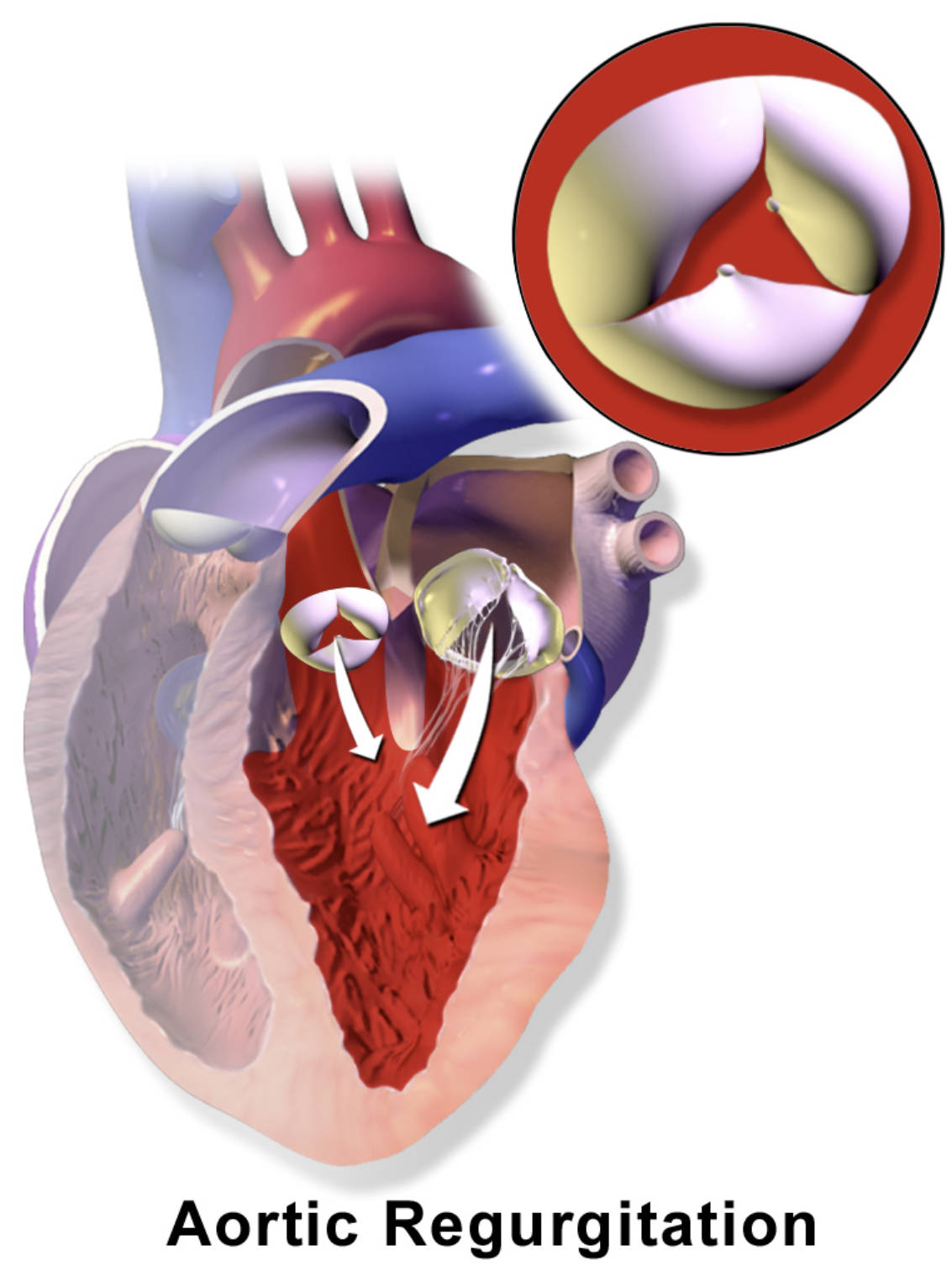 Aortic Regurgitation: Understanding the Impact of a Leaky Aortic Valve