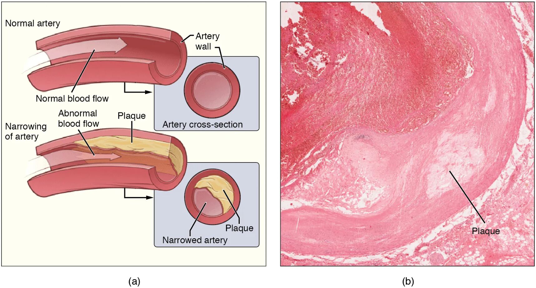 Atherosclerosis: Diagram and Microscopic View Explained