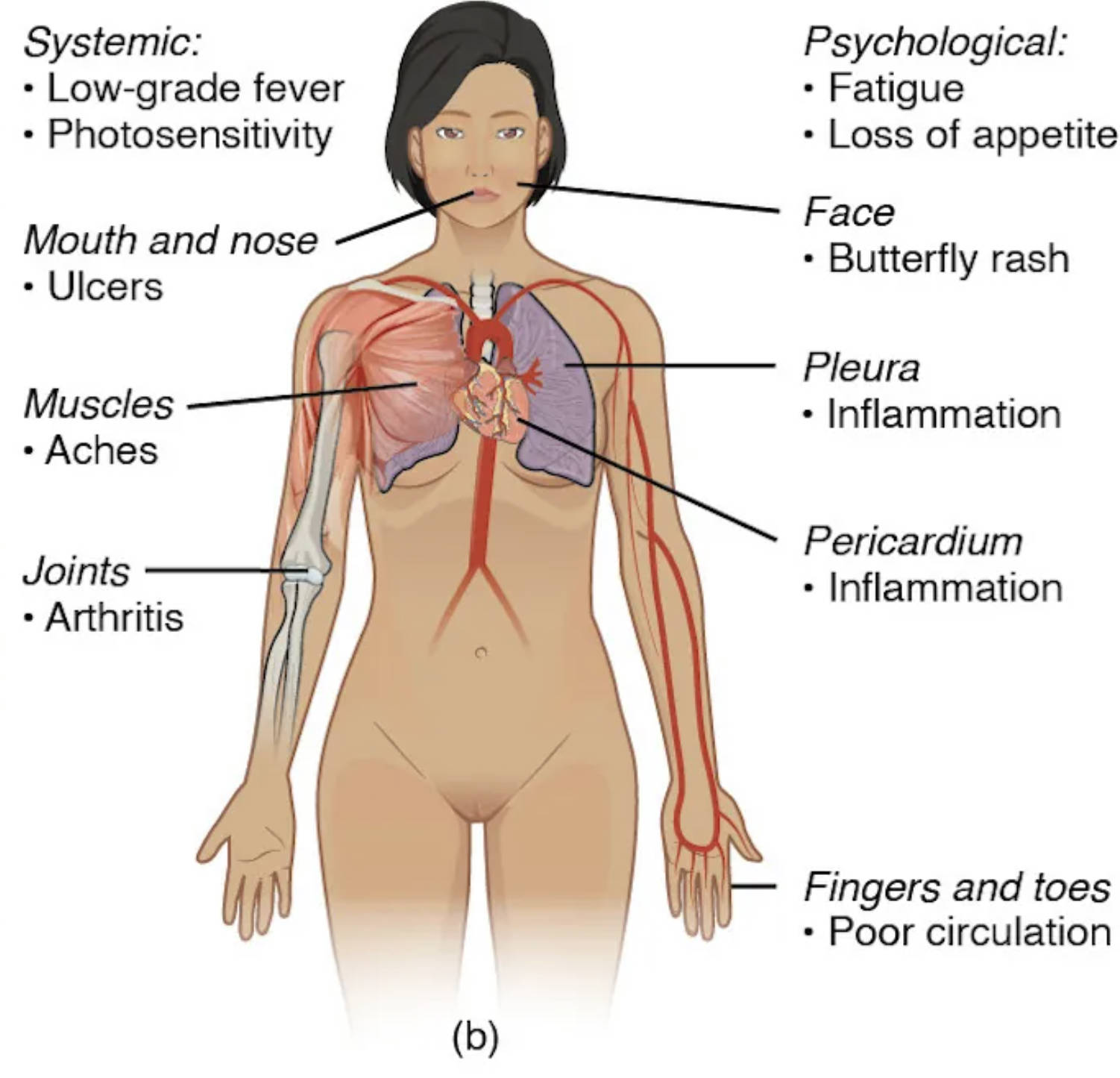 Systemic Lupus Erythematosus Symptoms: A Comprehensive Overview