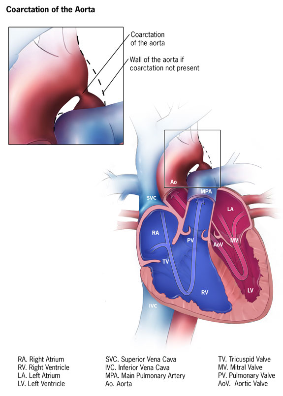 Coarctation of the Aorta: Understanding a Critical Congenital Heart Defect
