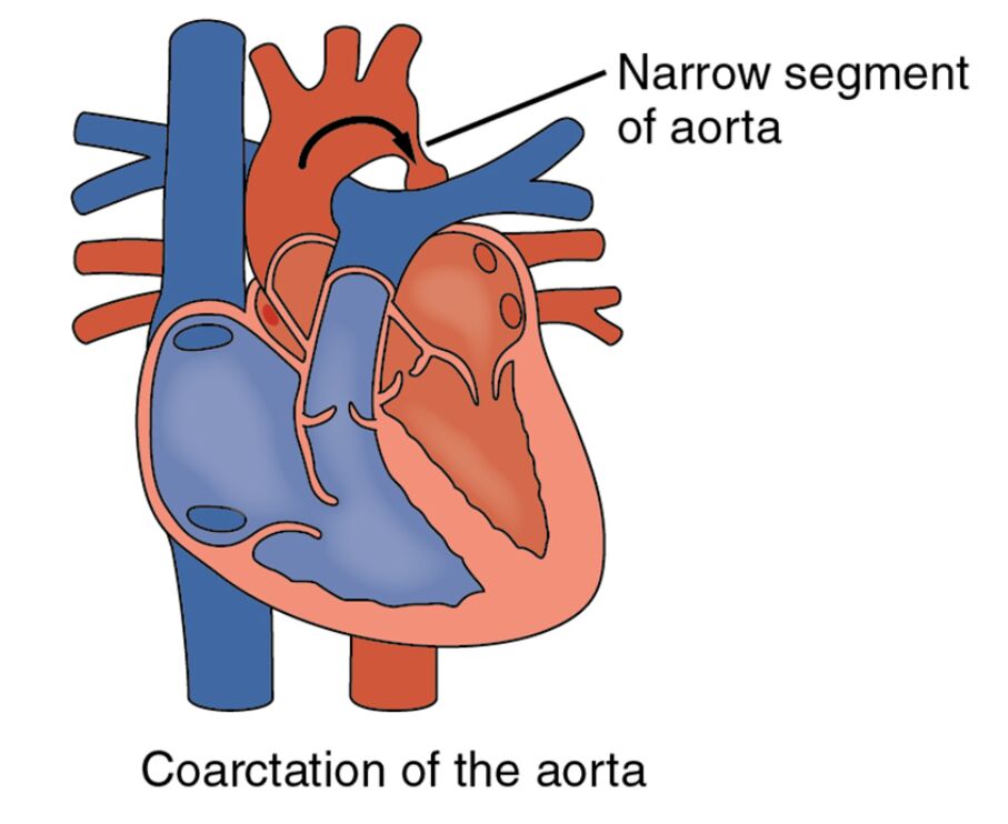 Congenital Heart Defect: Coarctation of the Aorta Explained