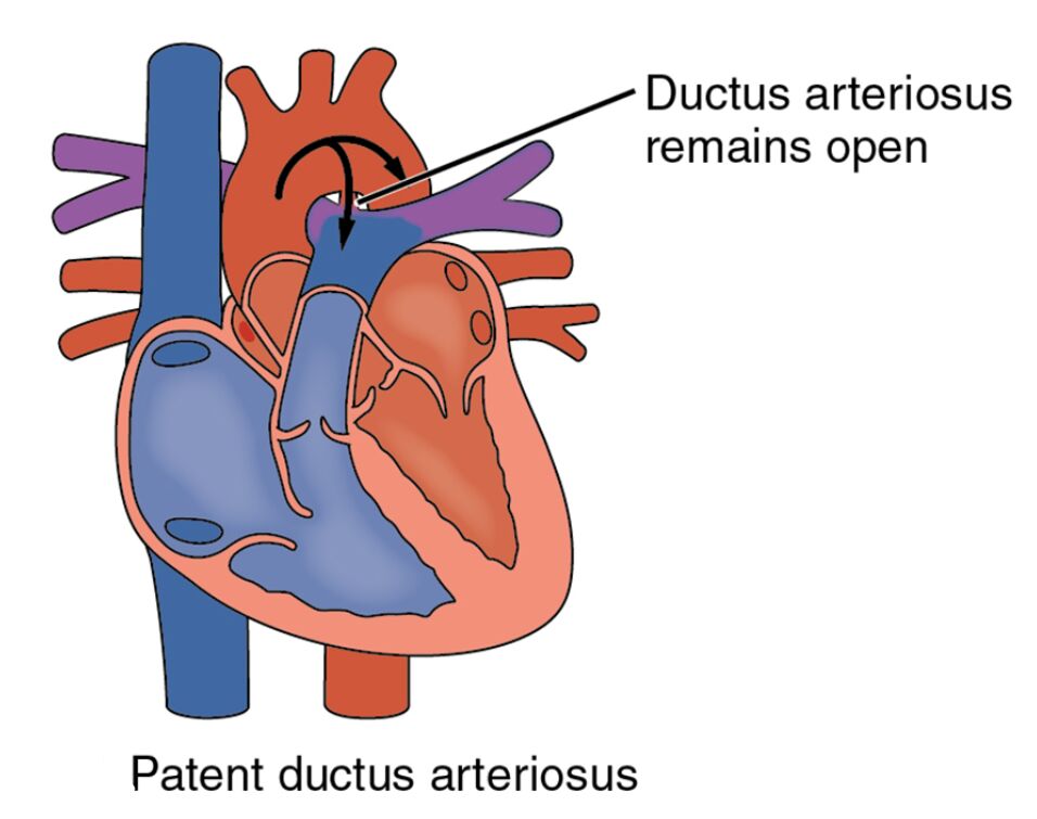Congenital Heart Defect: Patent Ductus Arteriosus Explained