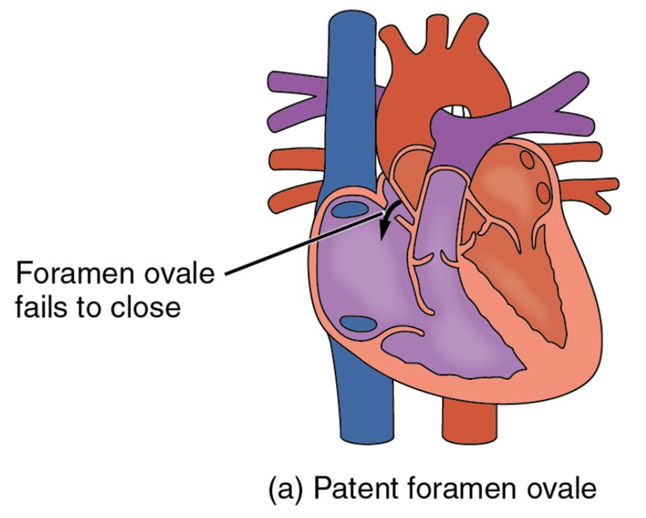 Congenital Heart Defect: Patent Foramen Ovale Explained