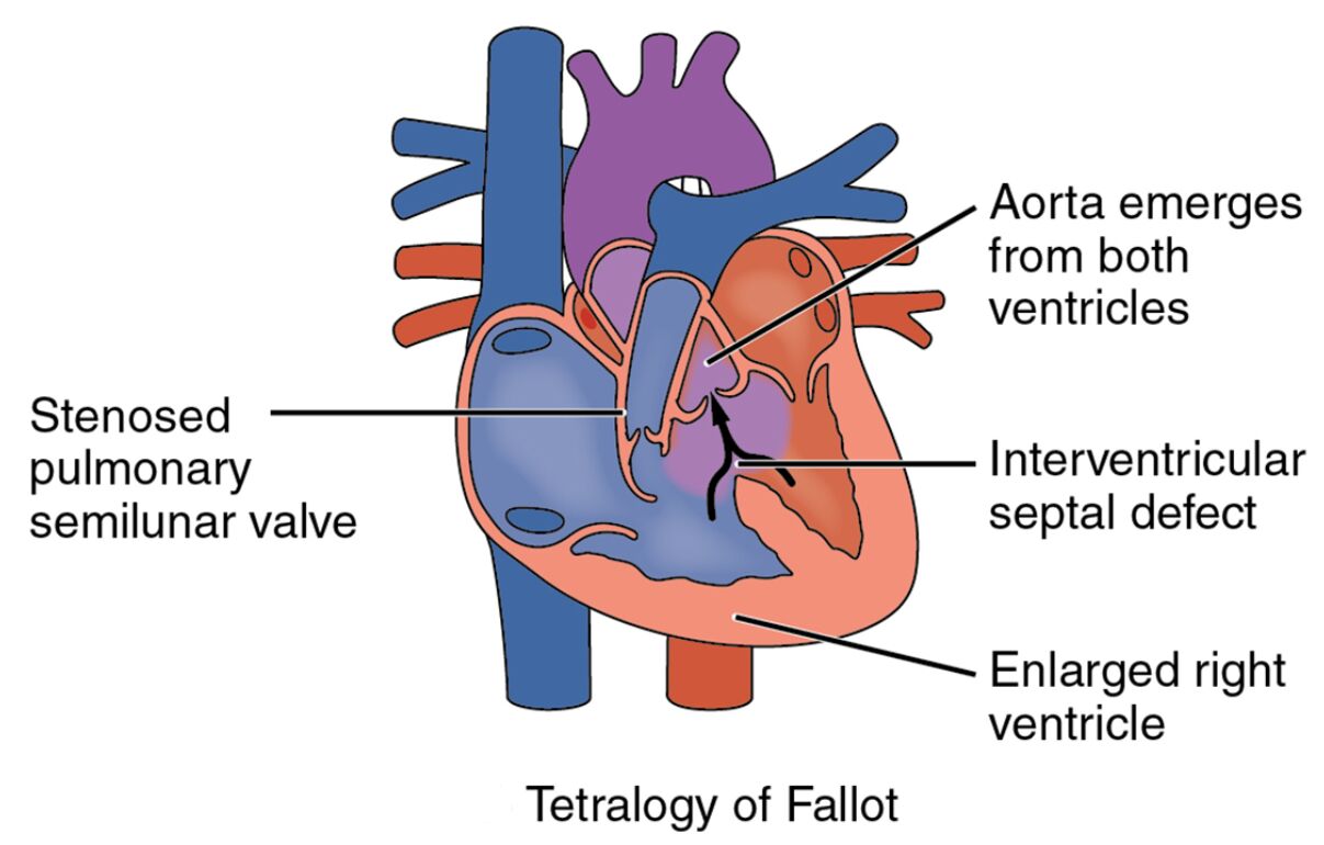 Congenital Heart Defect: Tetralogy of Fallot Explained