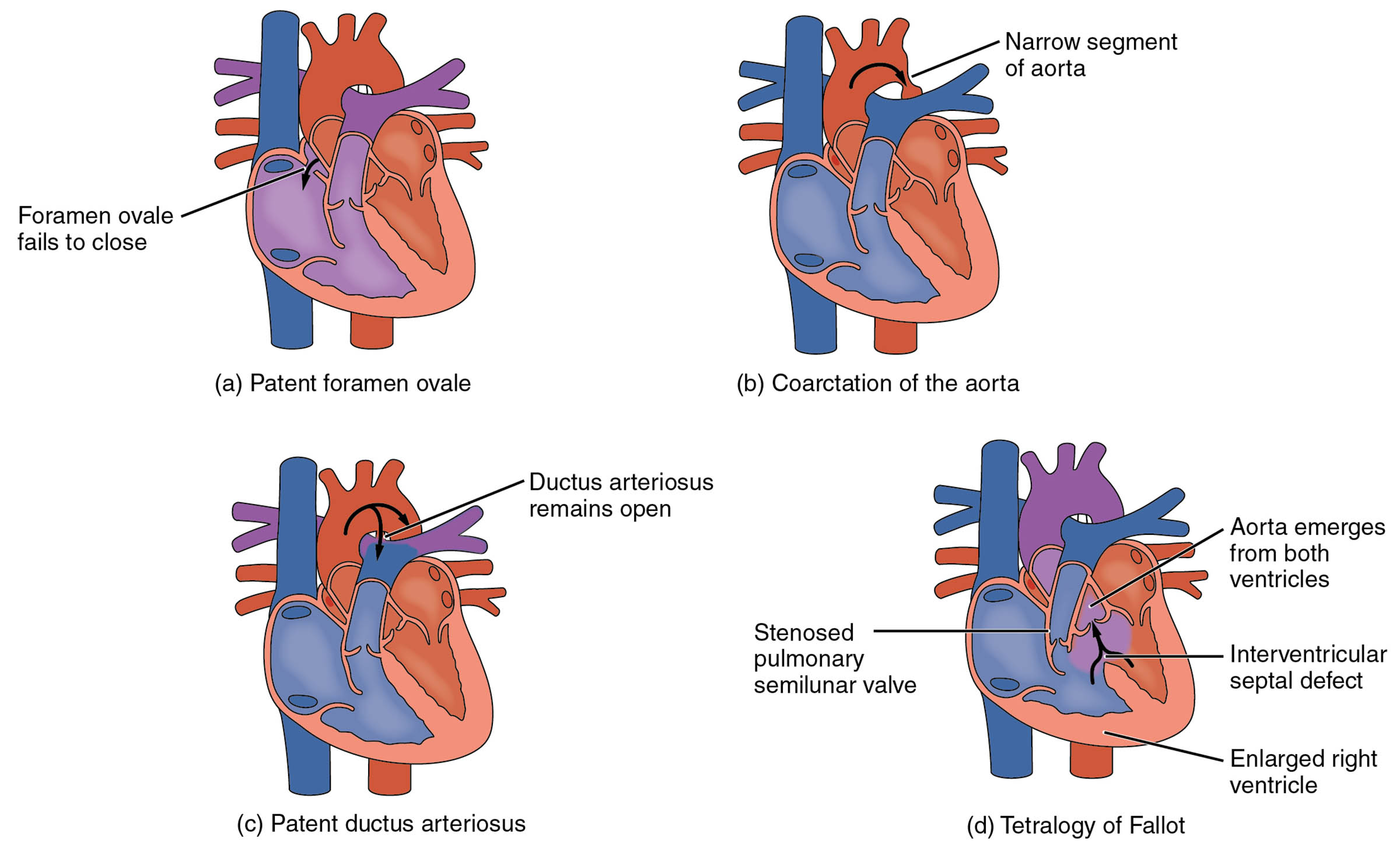Congenital Heart Defects: A Comprehensive Diagram