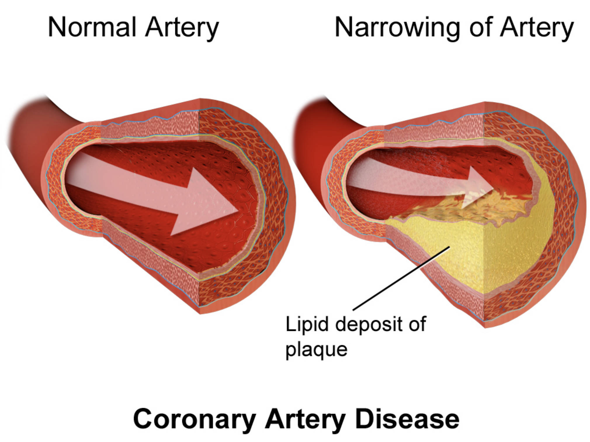 Coronary Artery Disease: Visualizing the Narrowing of Arteries