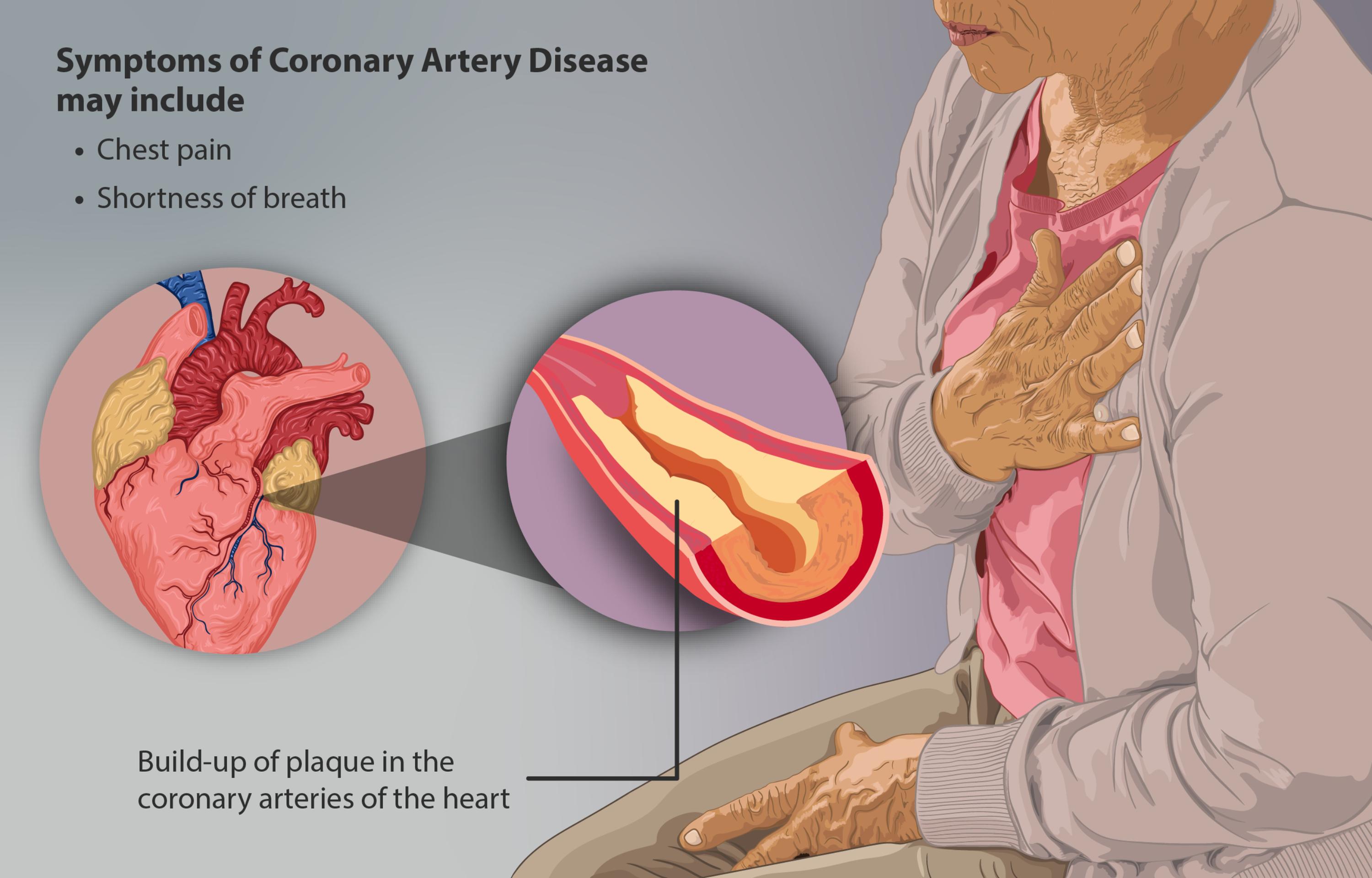 Understanding Coronary Artery Disease: Symptoms, Causes, and Management