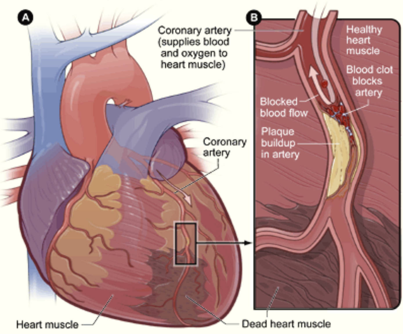Understanding Myocardial Infarction: The Mechanism of a Heart Attack