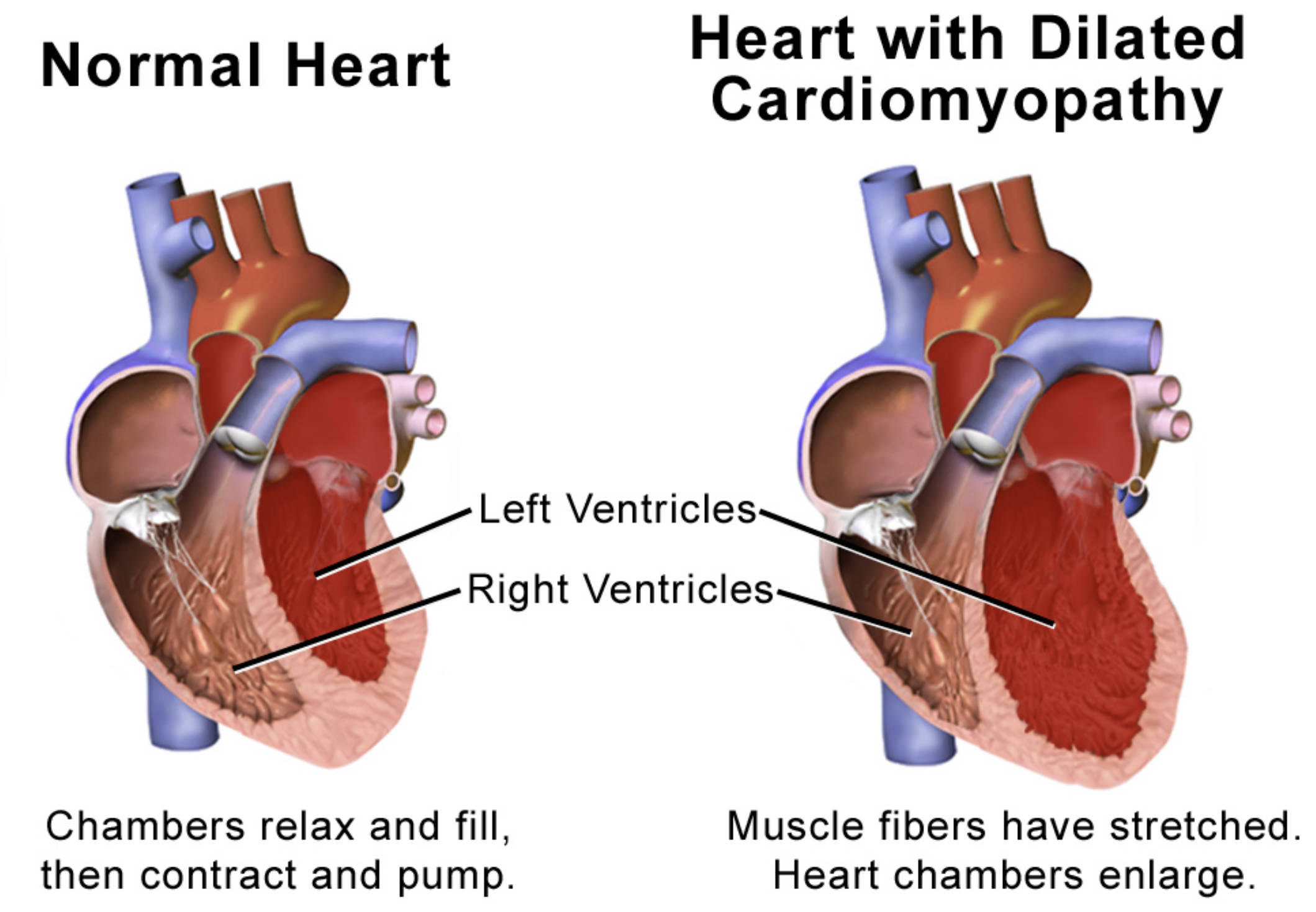 Dilated Cardiomyopathy: Understanding the Enlarged and Weakened Heart